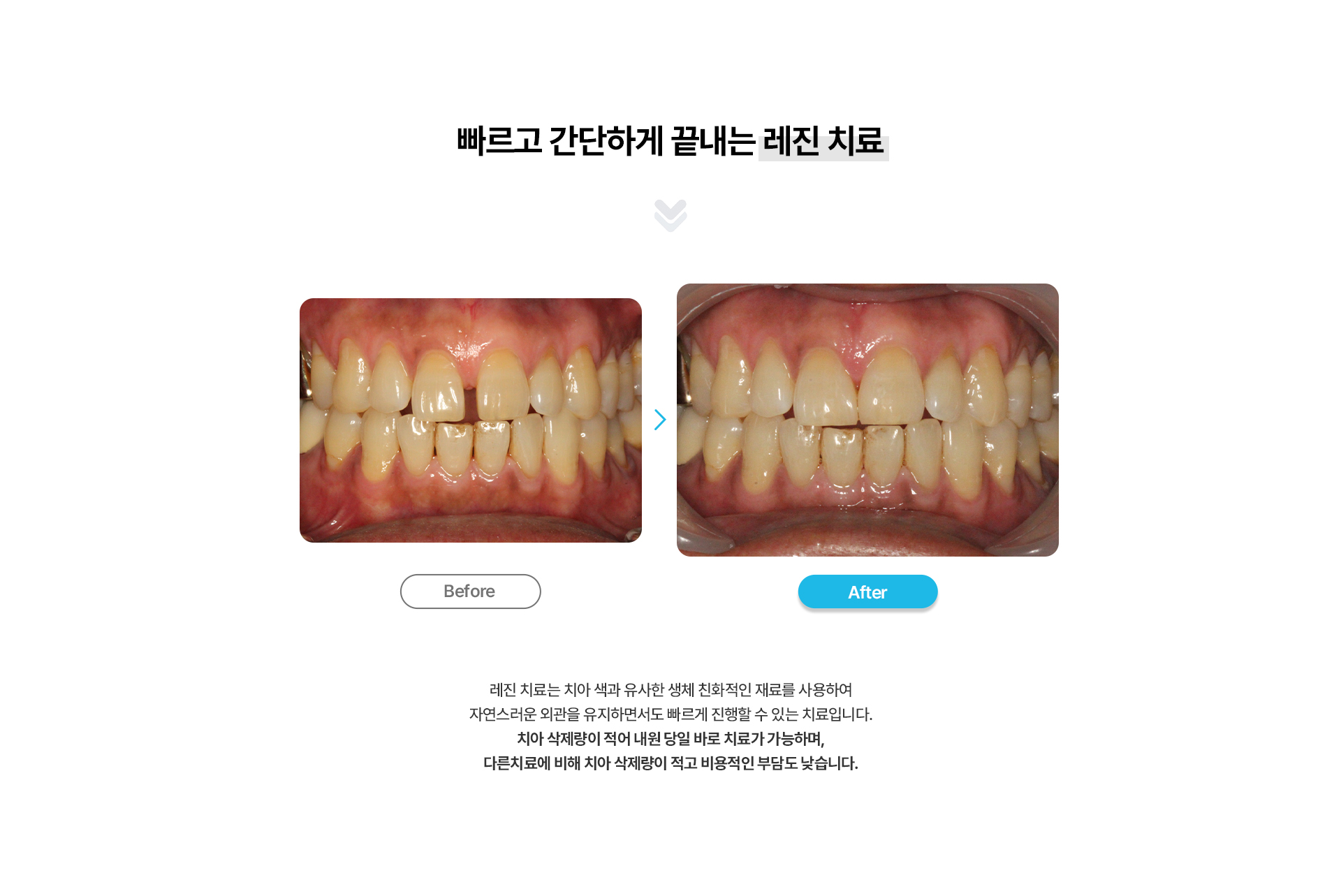 앞니레진치료