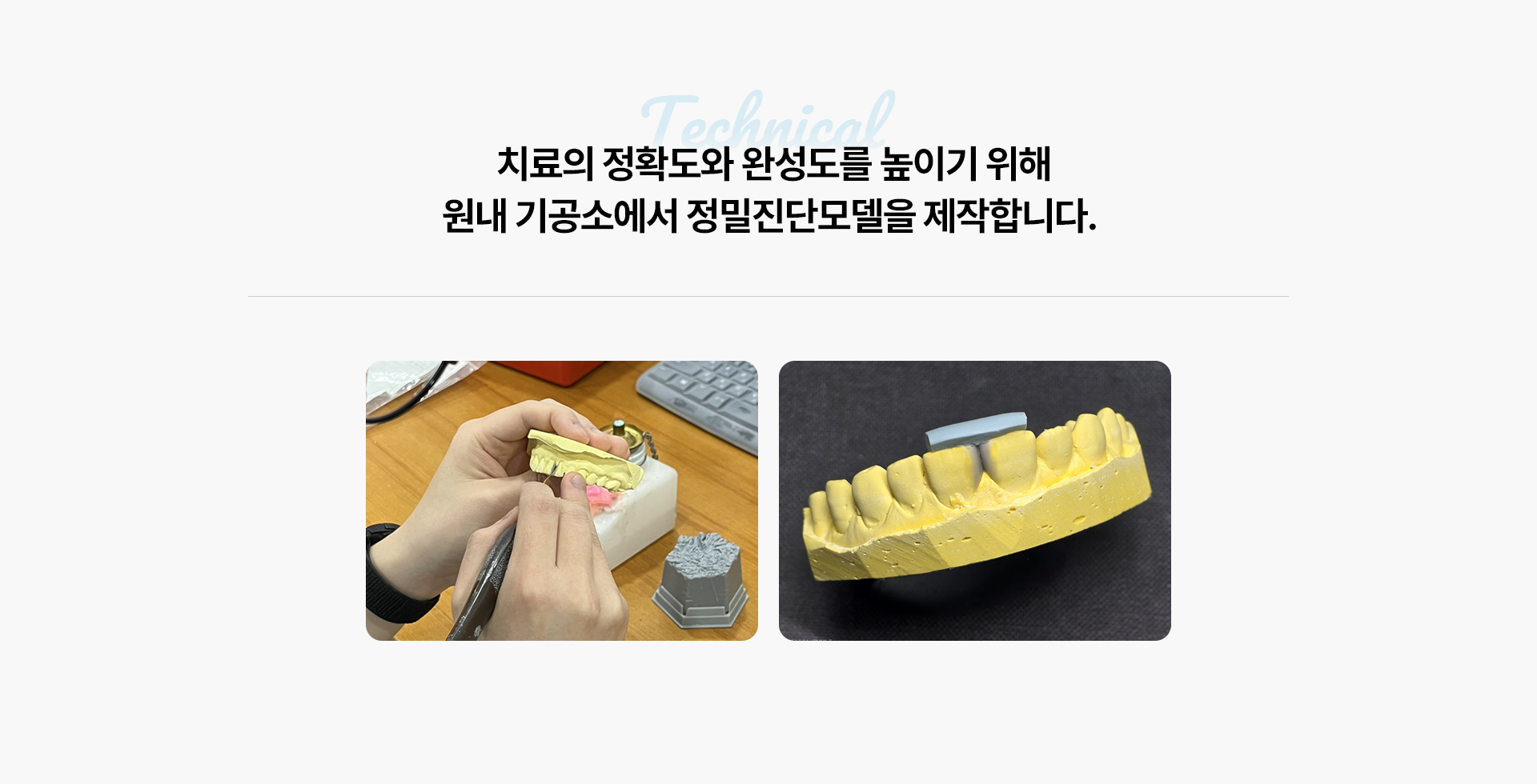 앞니레진치료