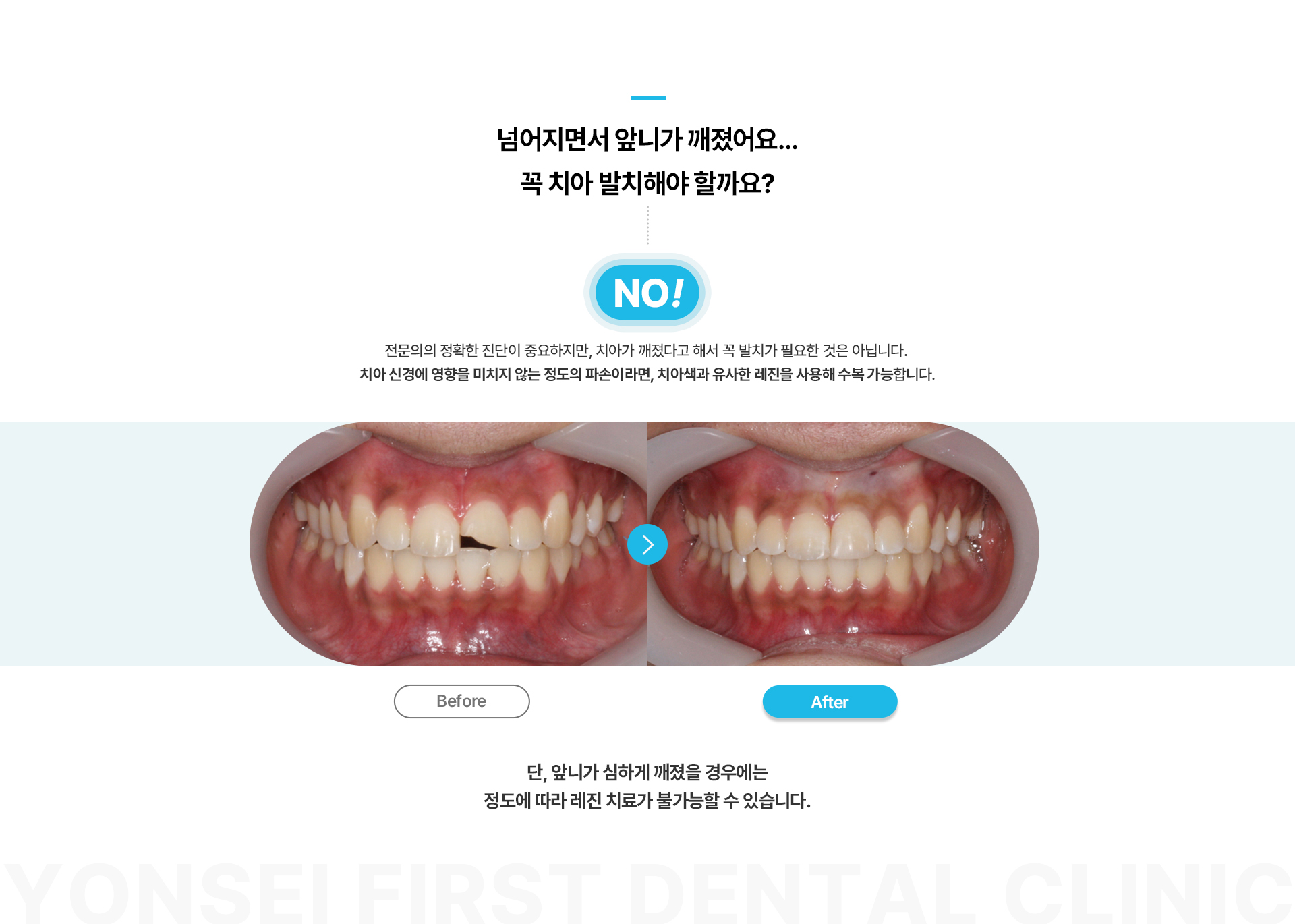 앞니레진치료