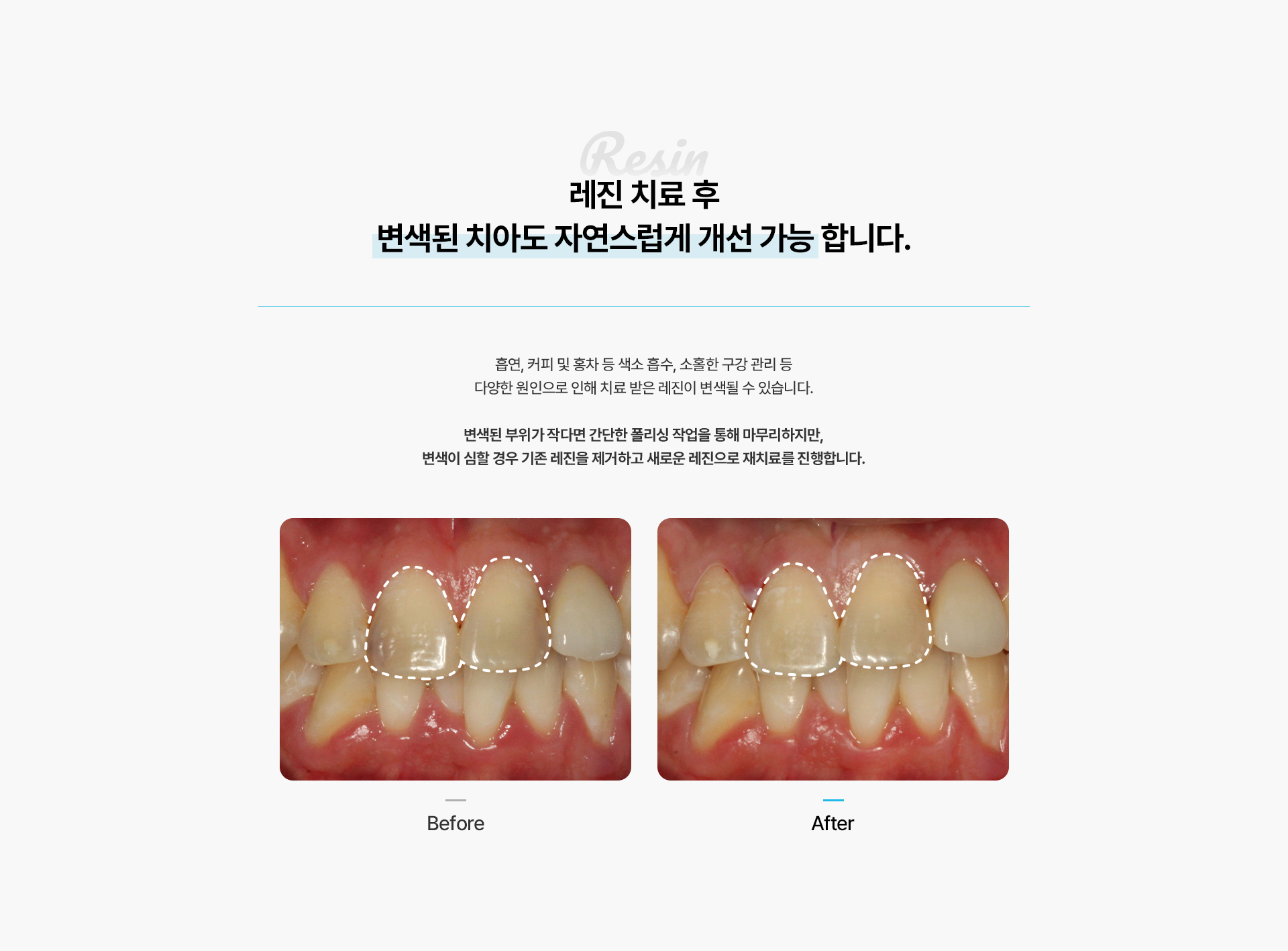 앞니레진치료