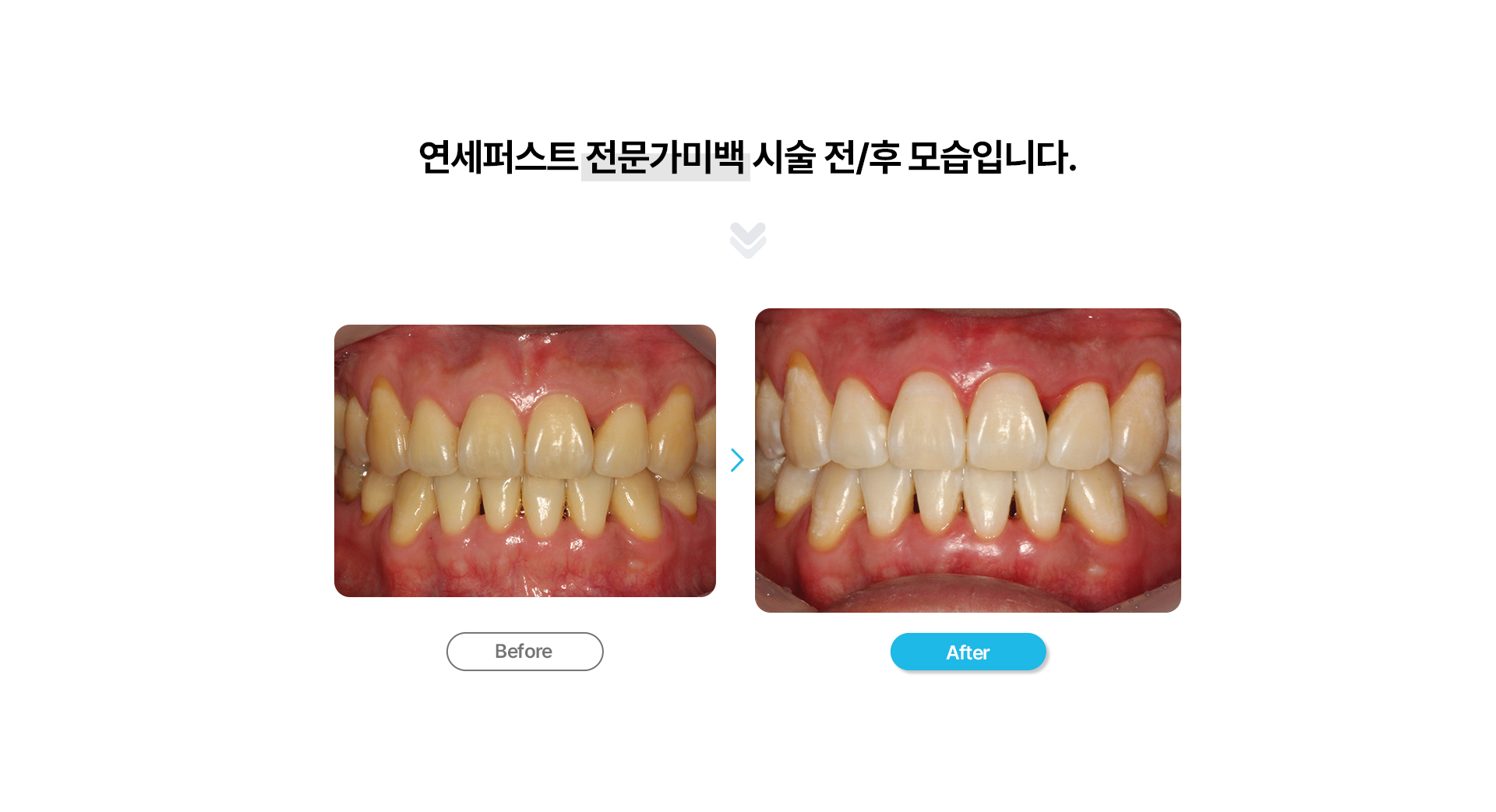 치아미백