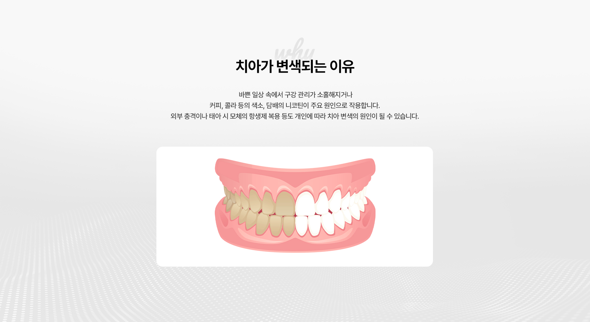 치아미백