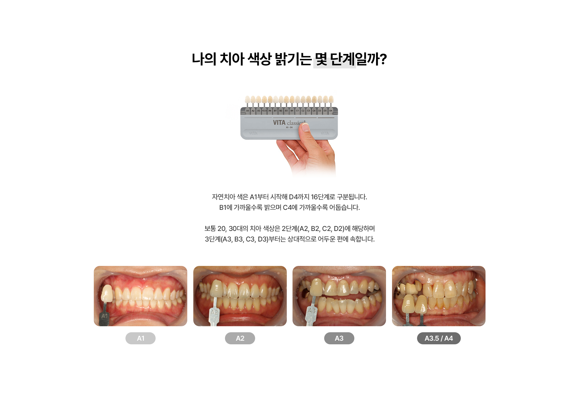 치아미백