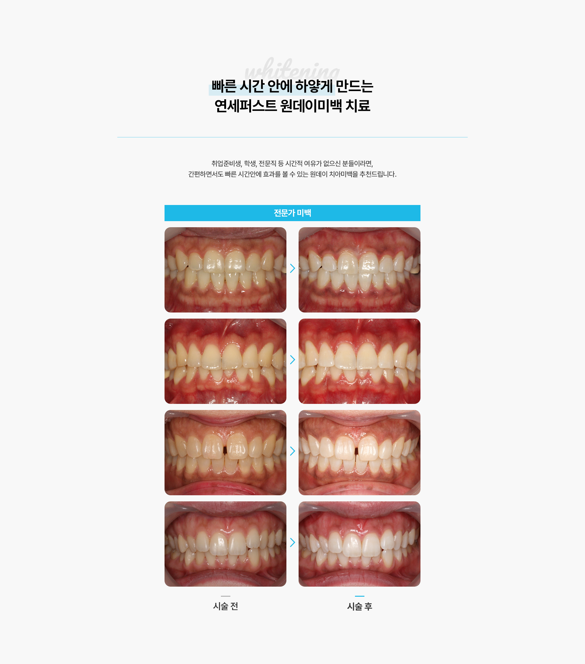 치아미백