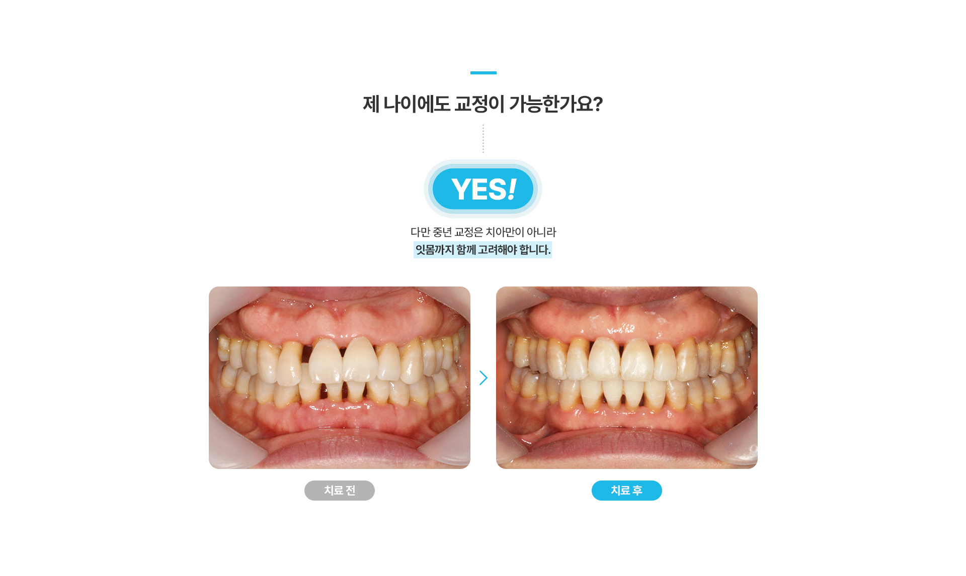 중년치주교정