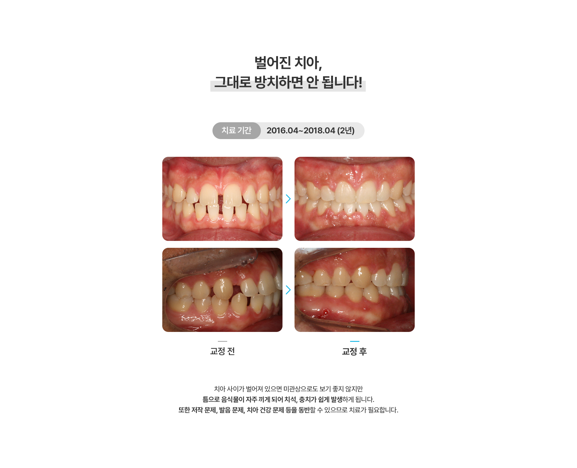 벌어진치아교정