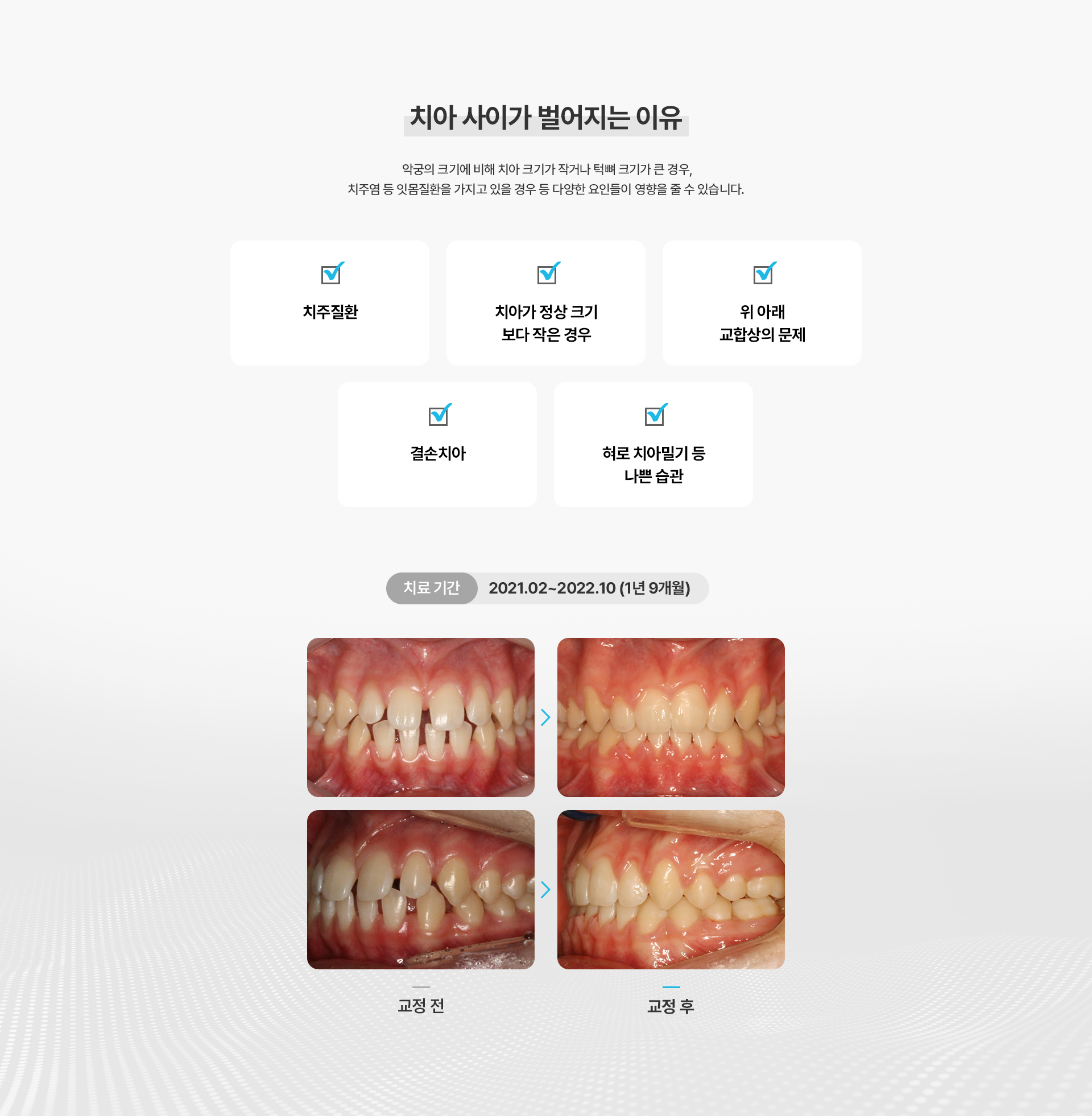 벌어진치아교정