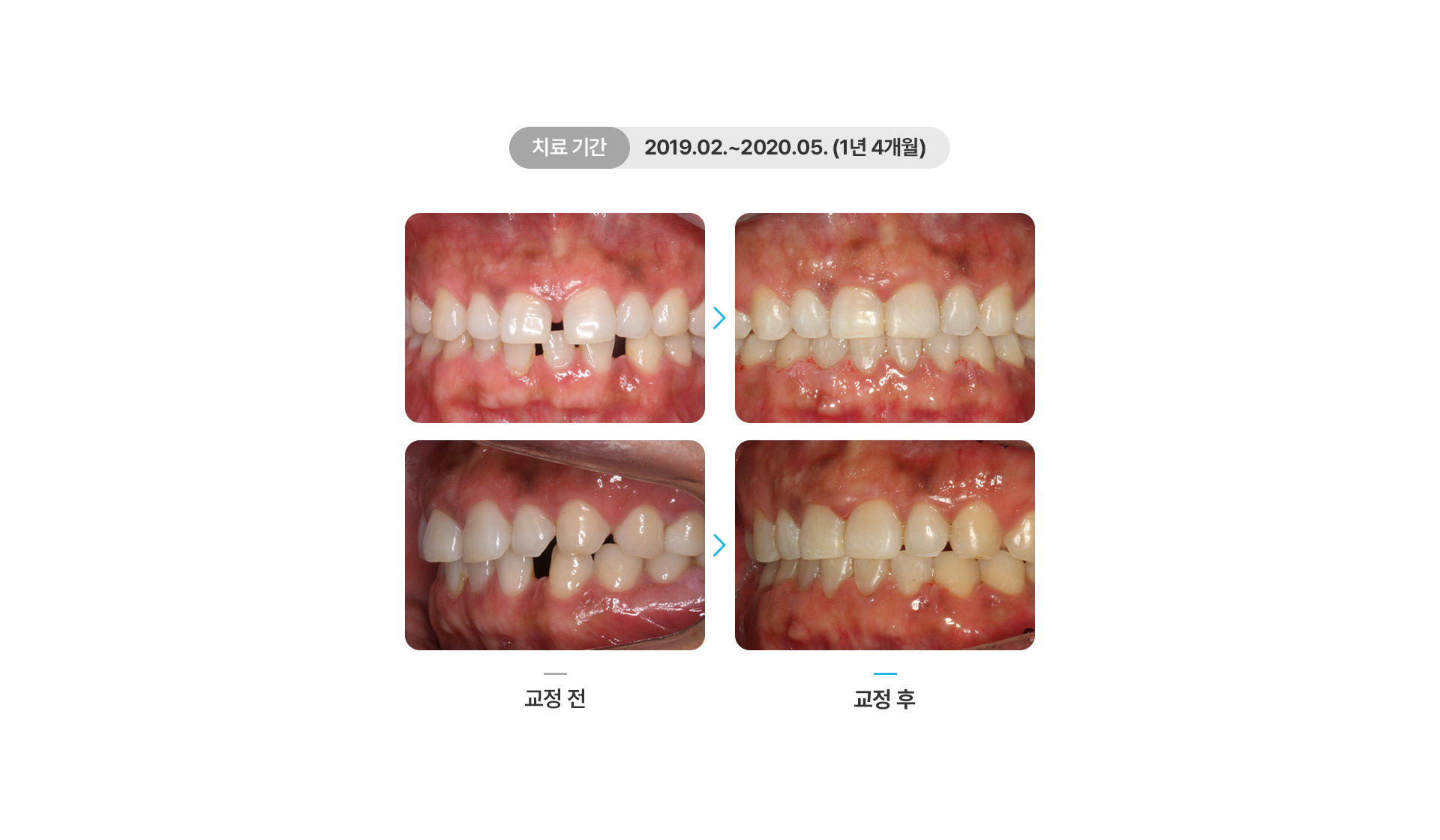 벌어진치아교정