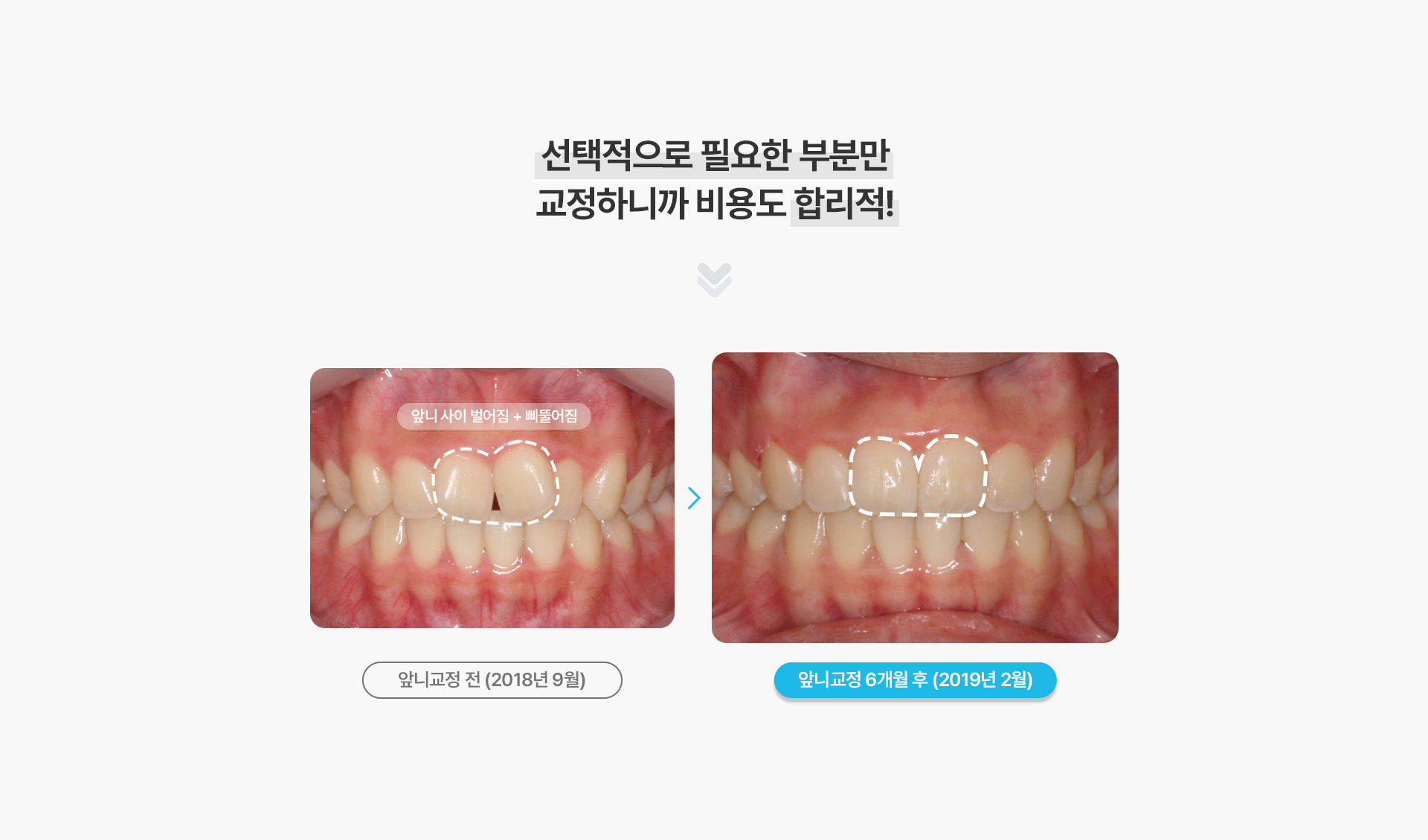 앞니부분교정