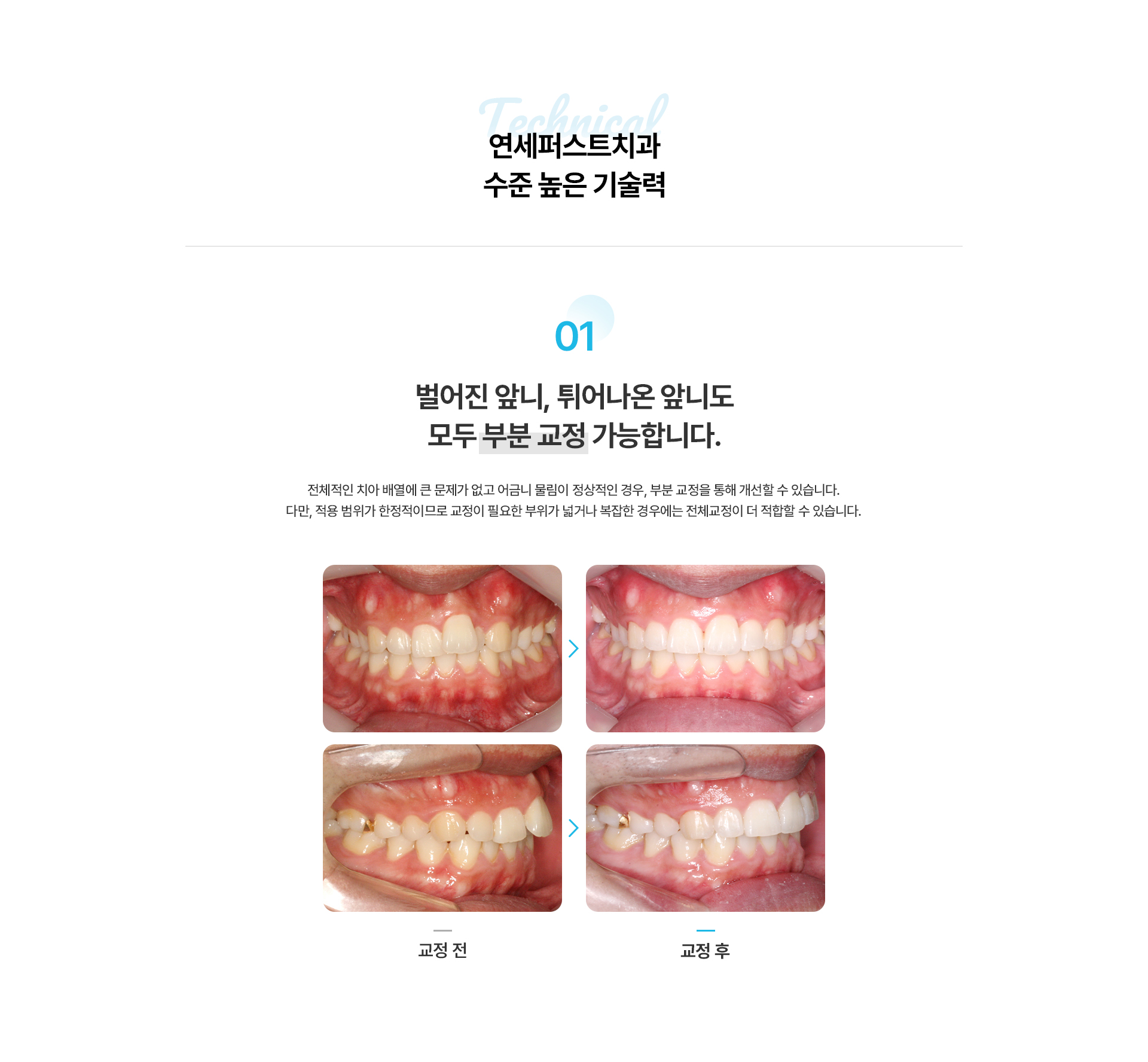 앞니부분교정