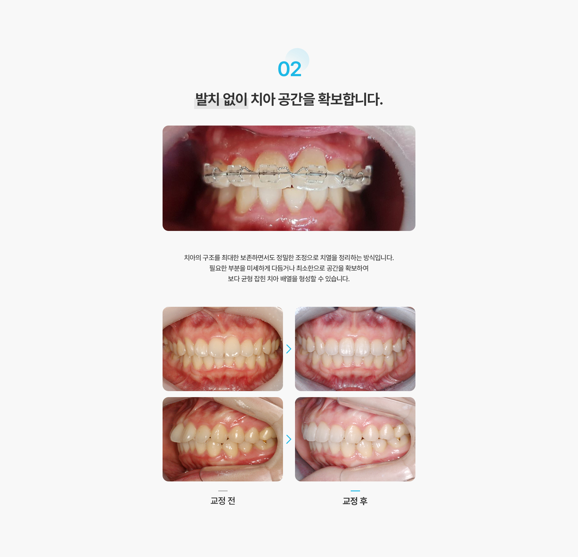 앞니부분교정
