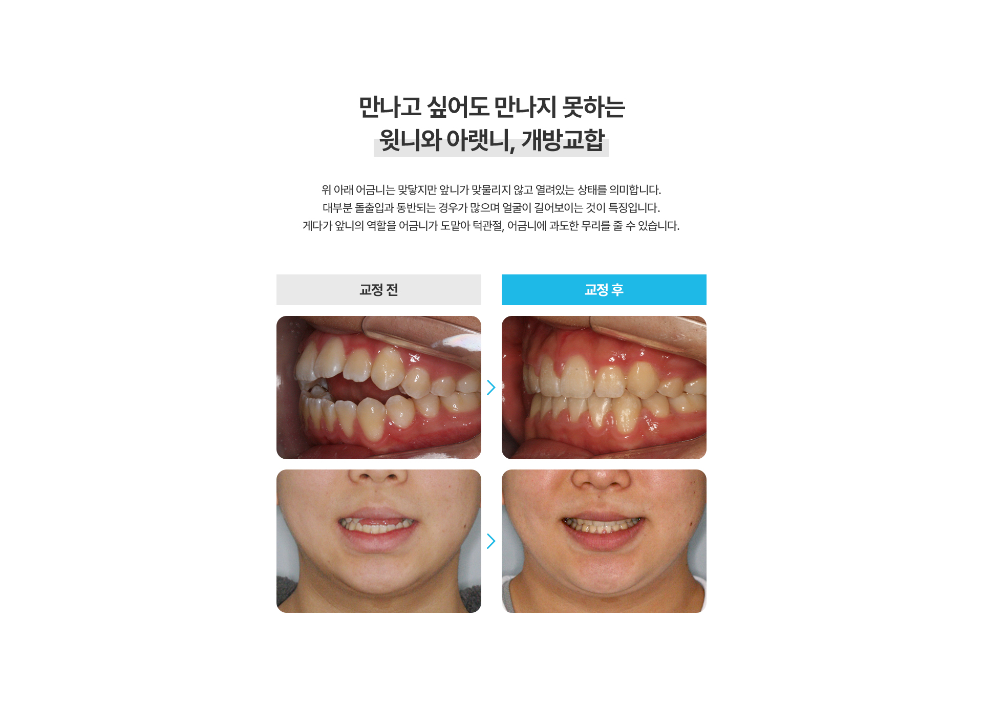 개방교합교정