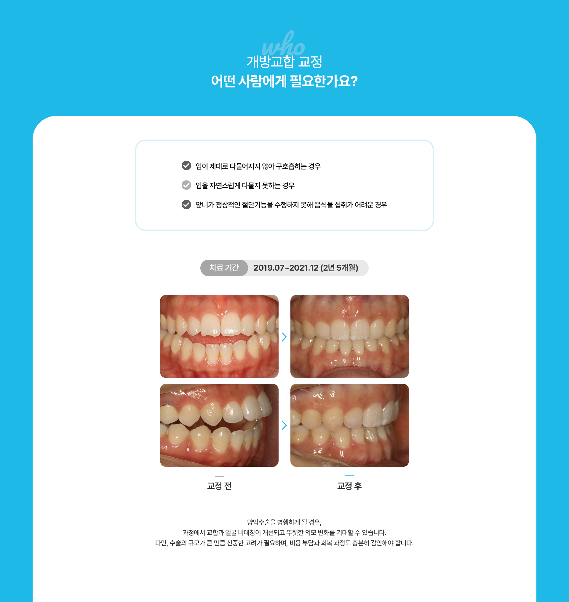 개방교합교정