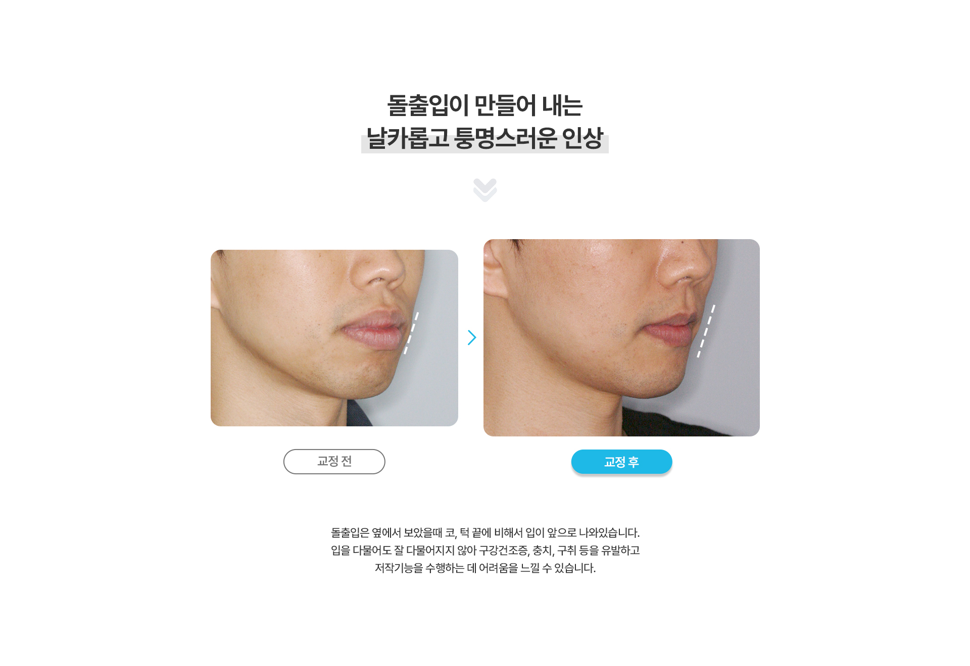 돌출입교정