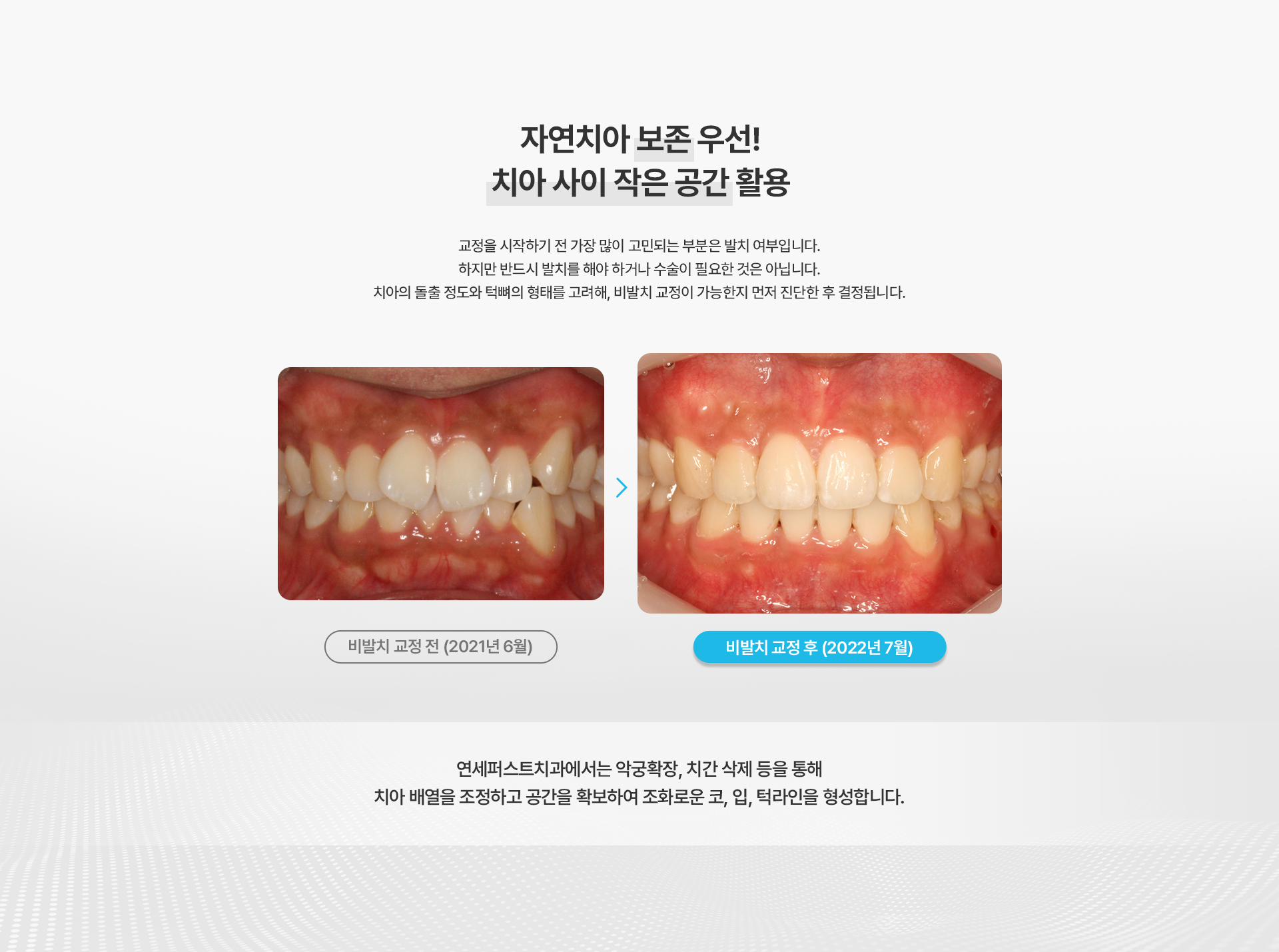 돌출입교정