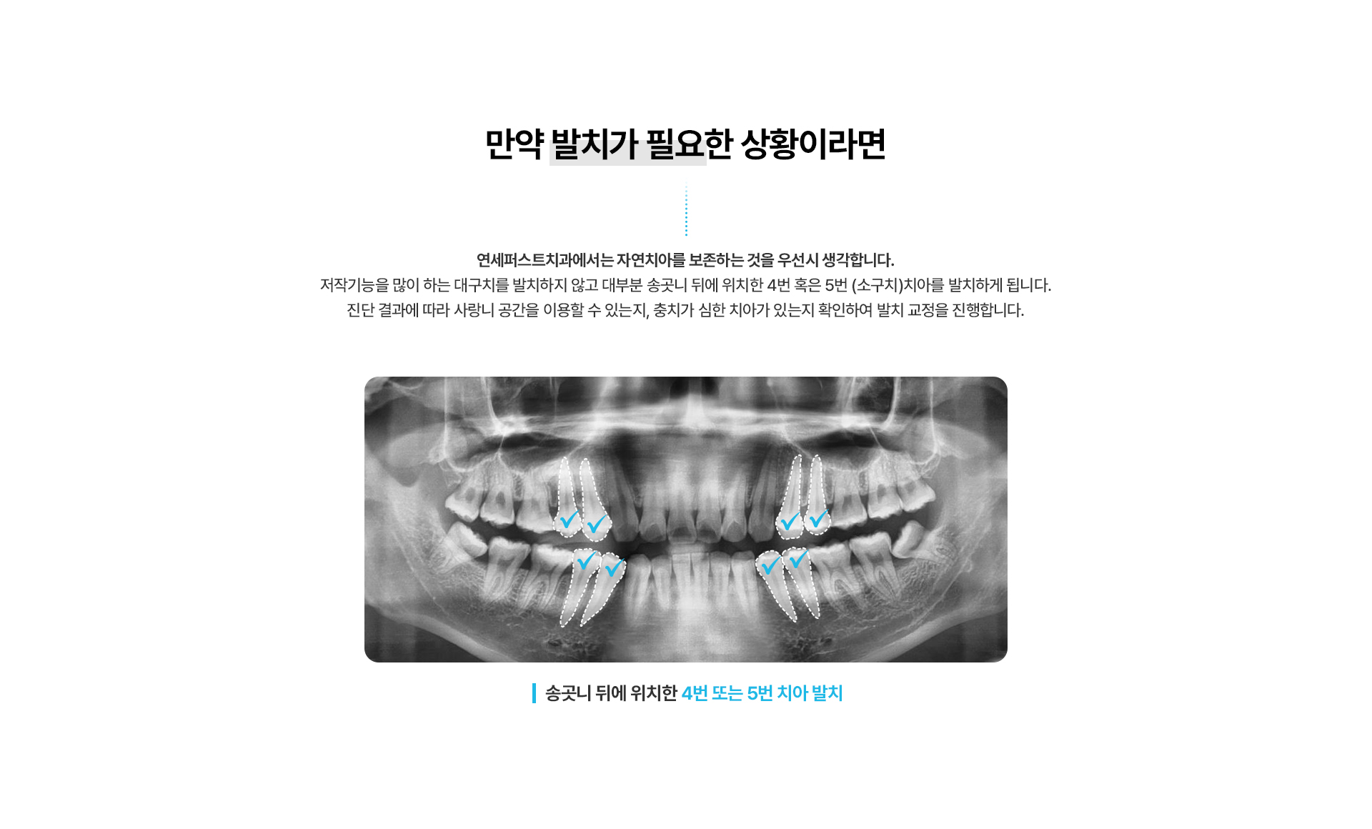 돌출입교정