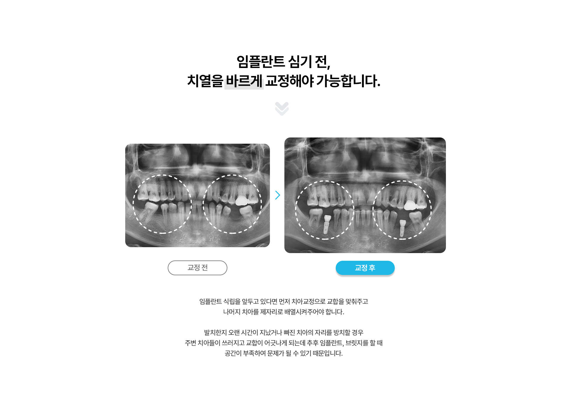 보철교정