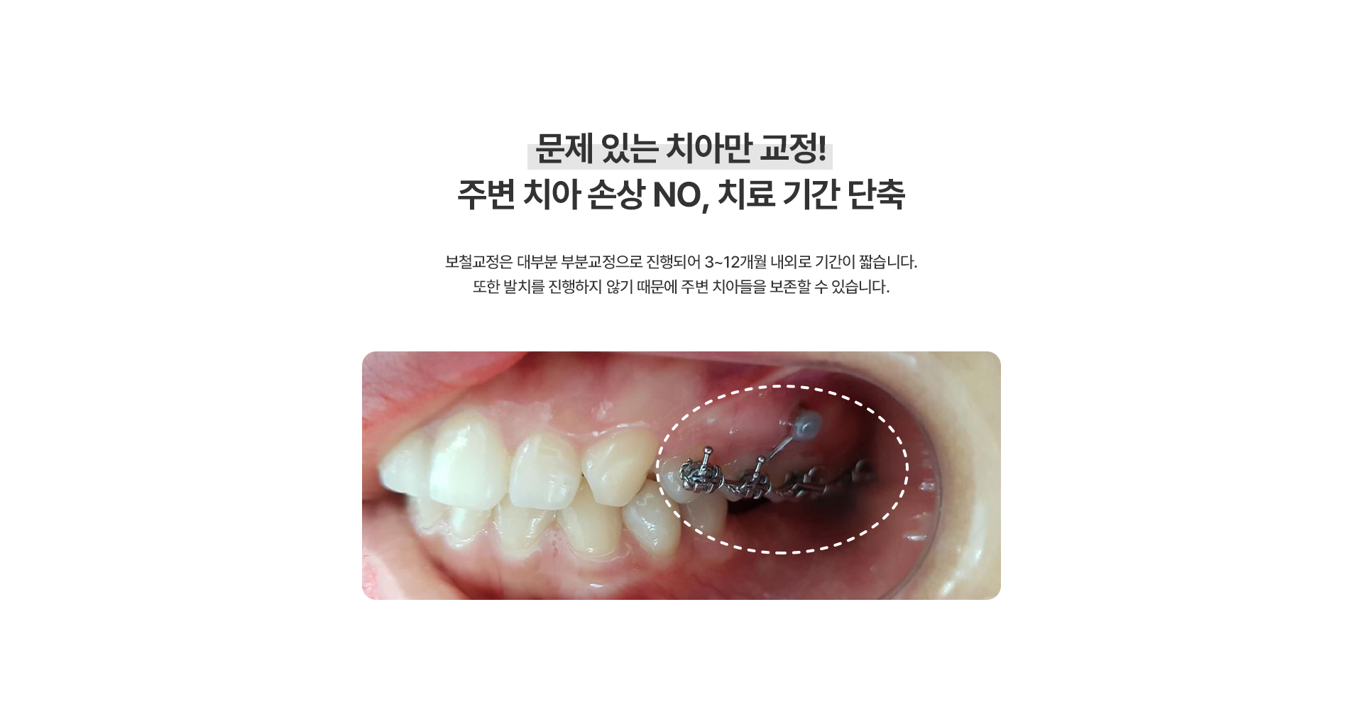 보철교정