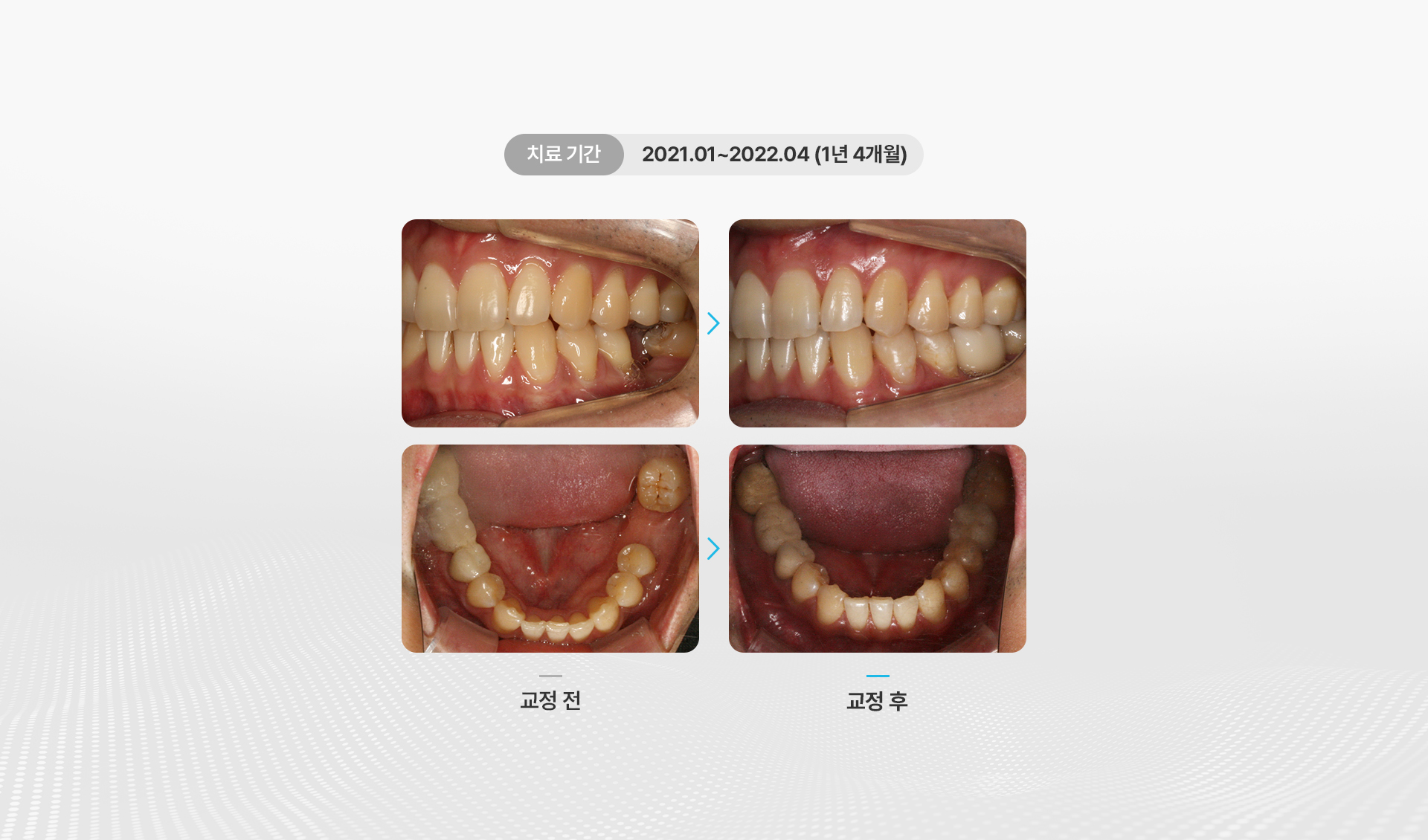 보철교정