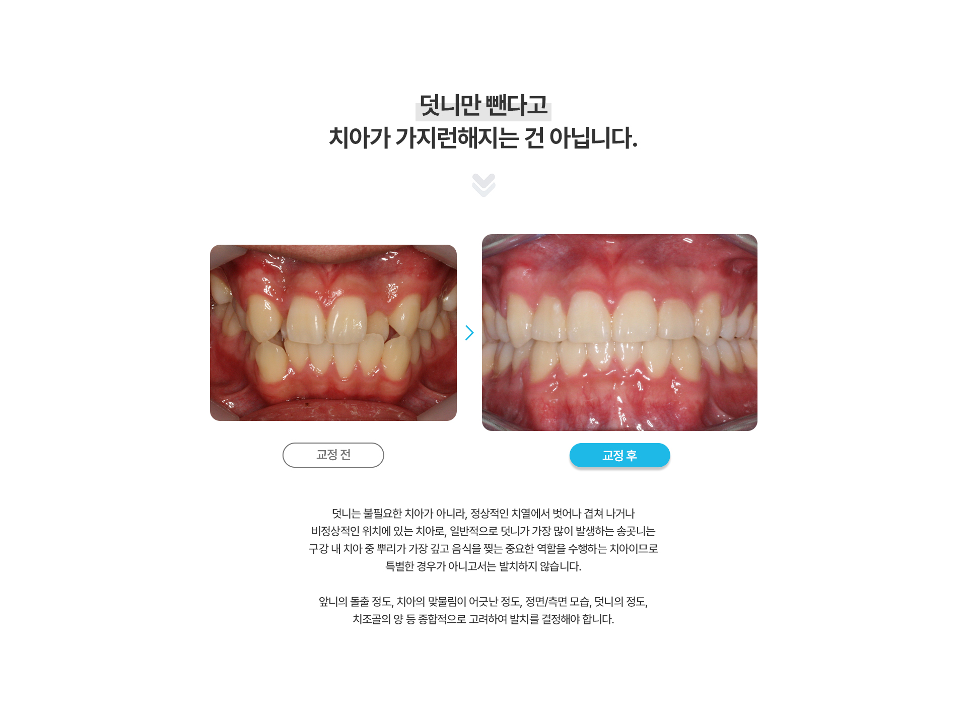 덧니교정