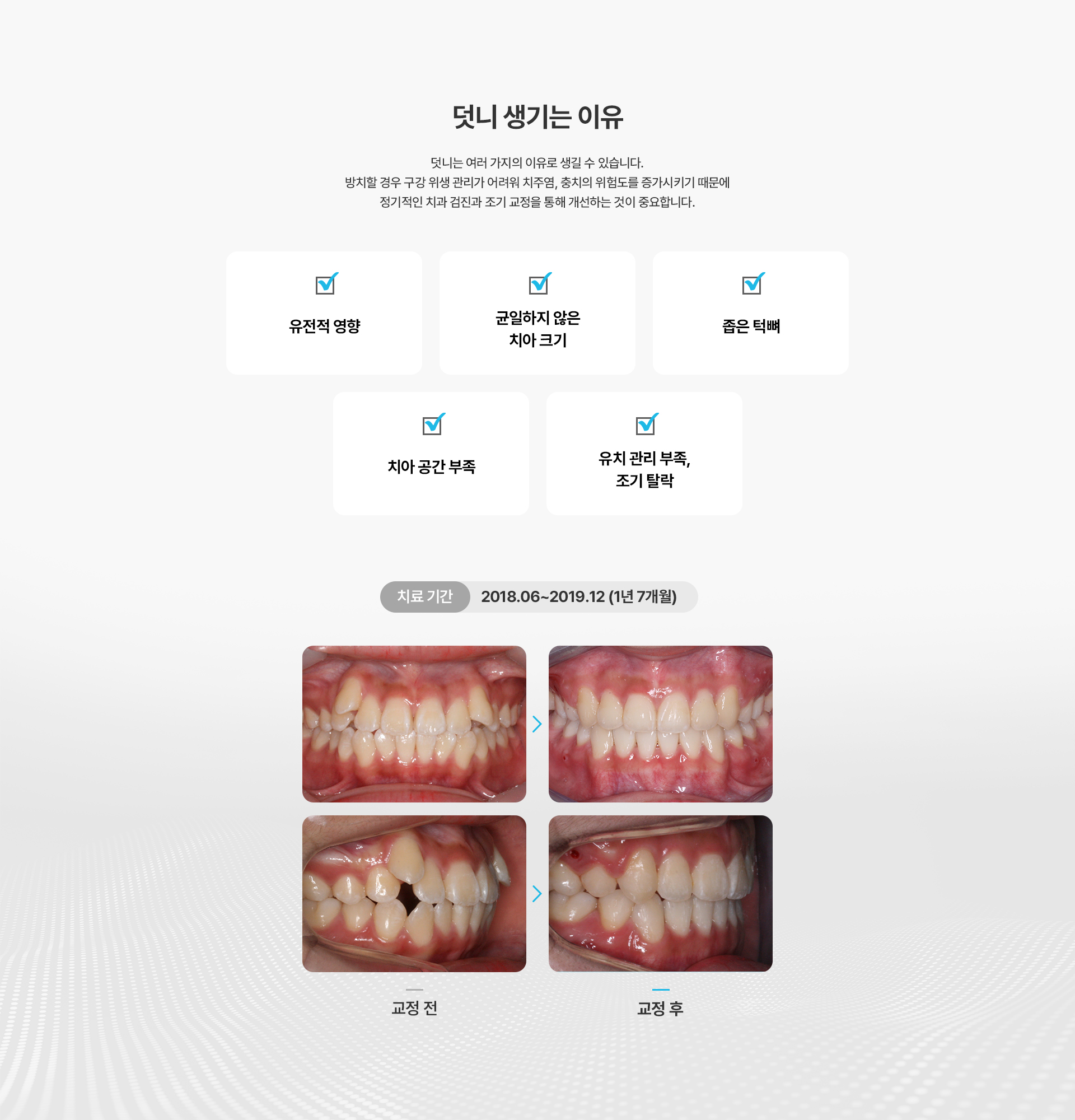 덧니교정