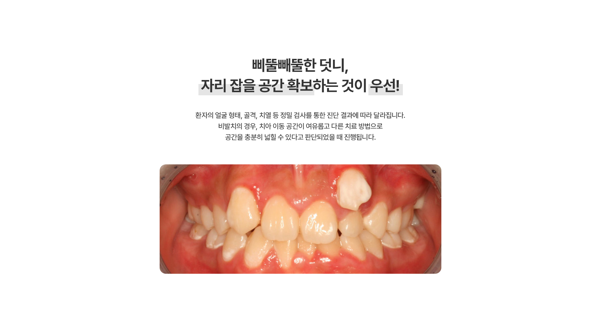 덧니교정