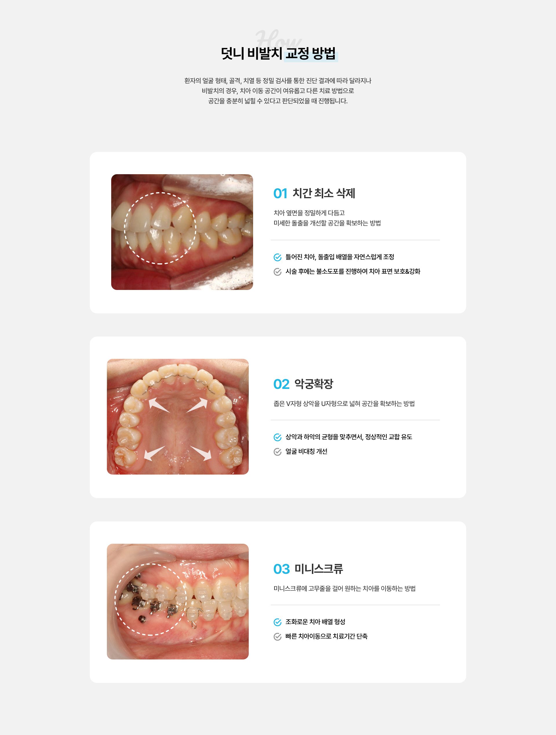 덧니교정