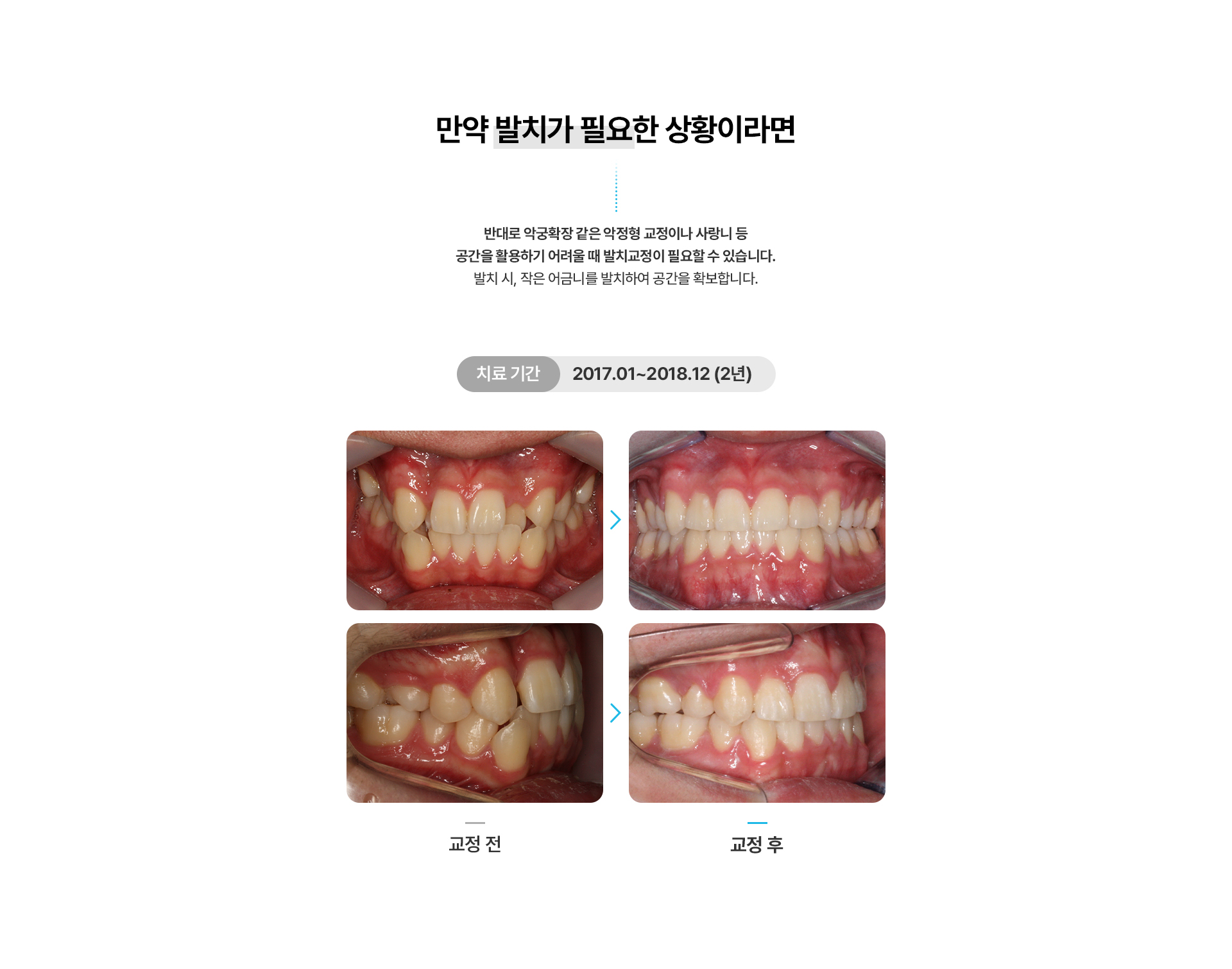 덧니교정