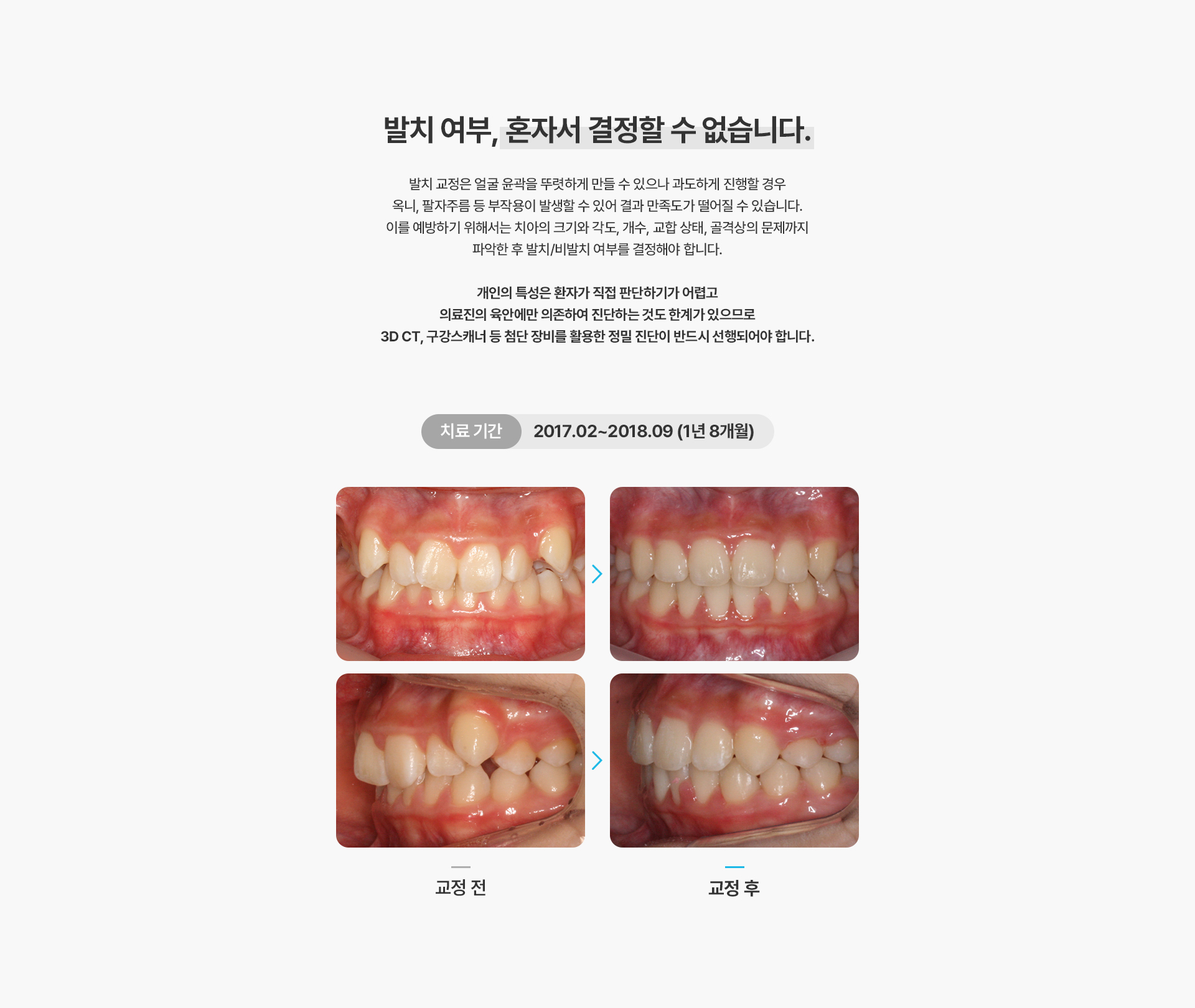 덧니교정