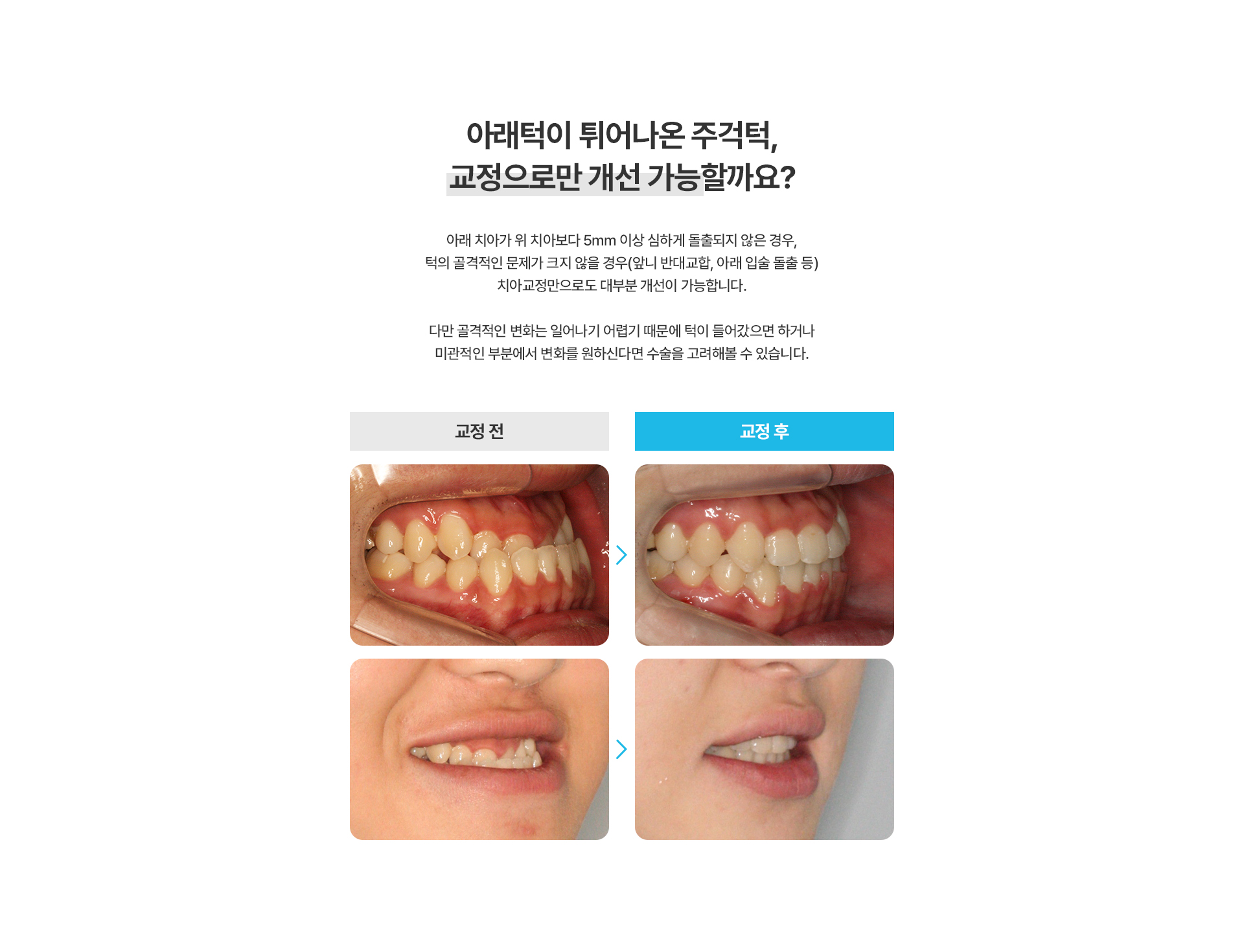 주걱턱교정