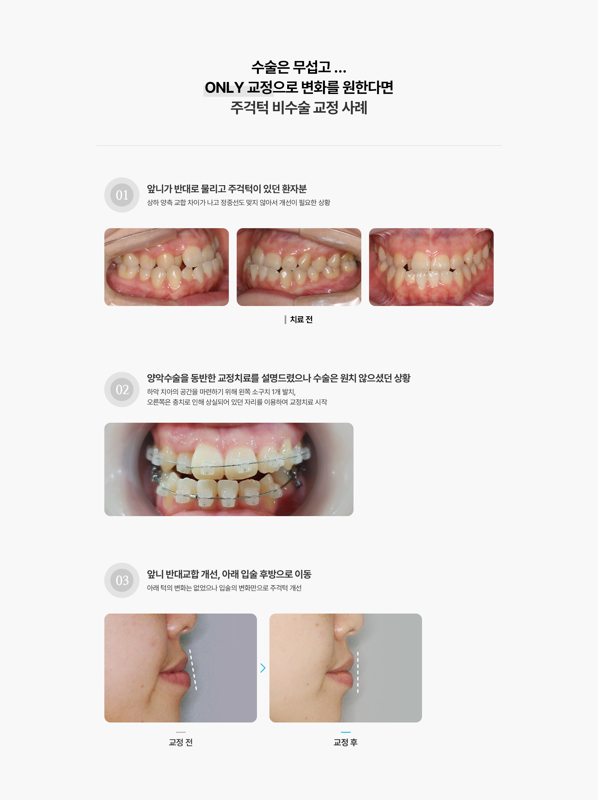 주걱턱교정