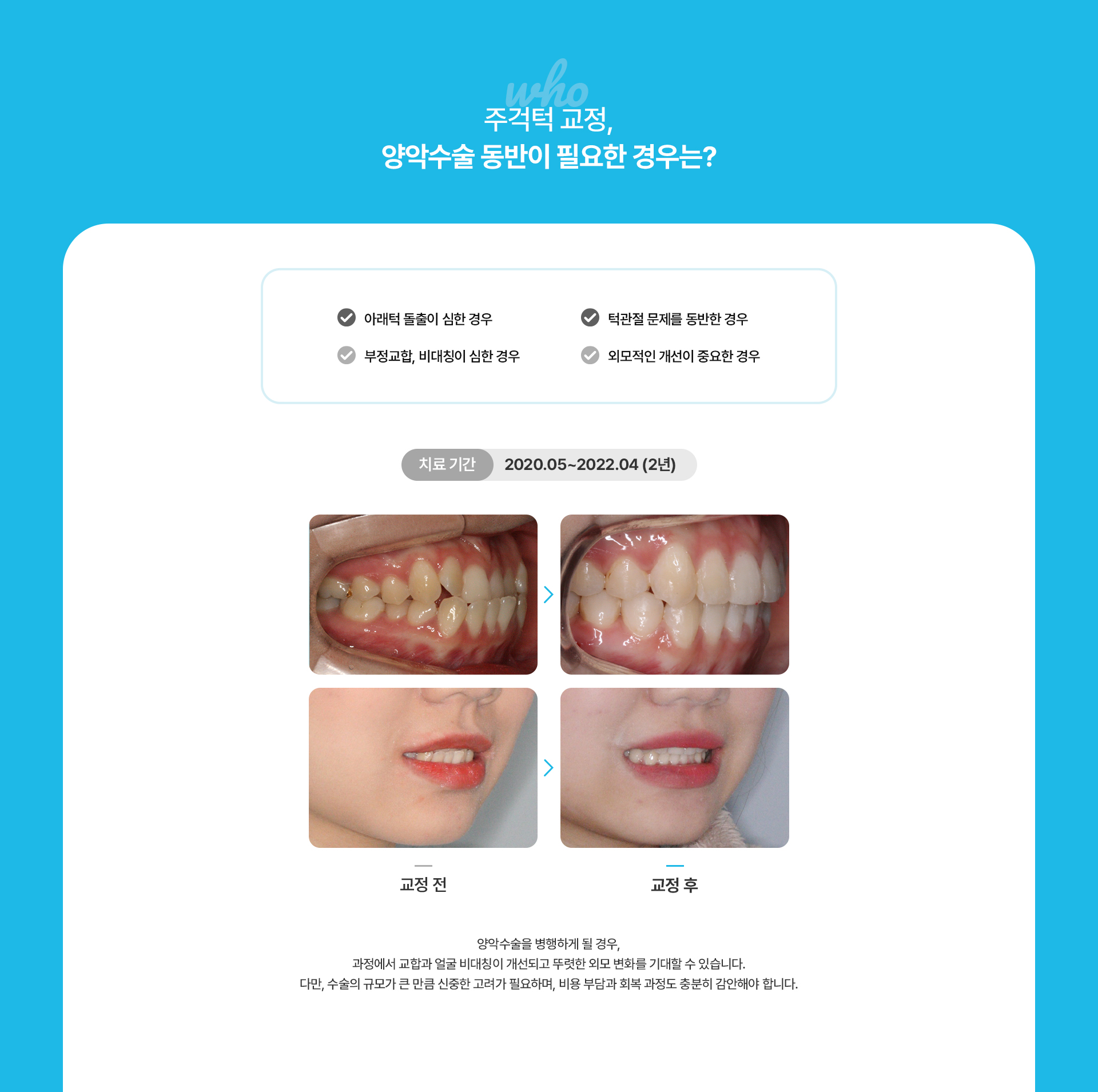 주걱턱교정
