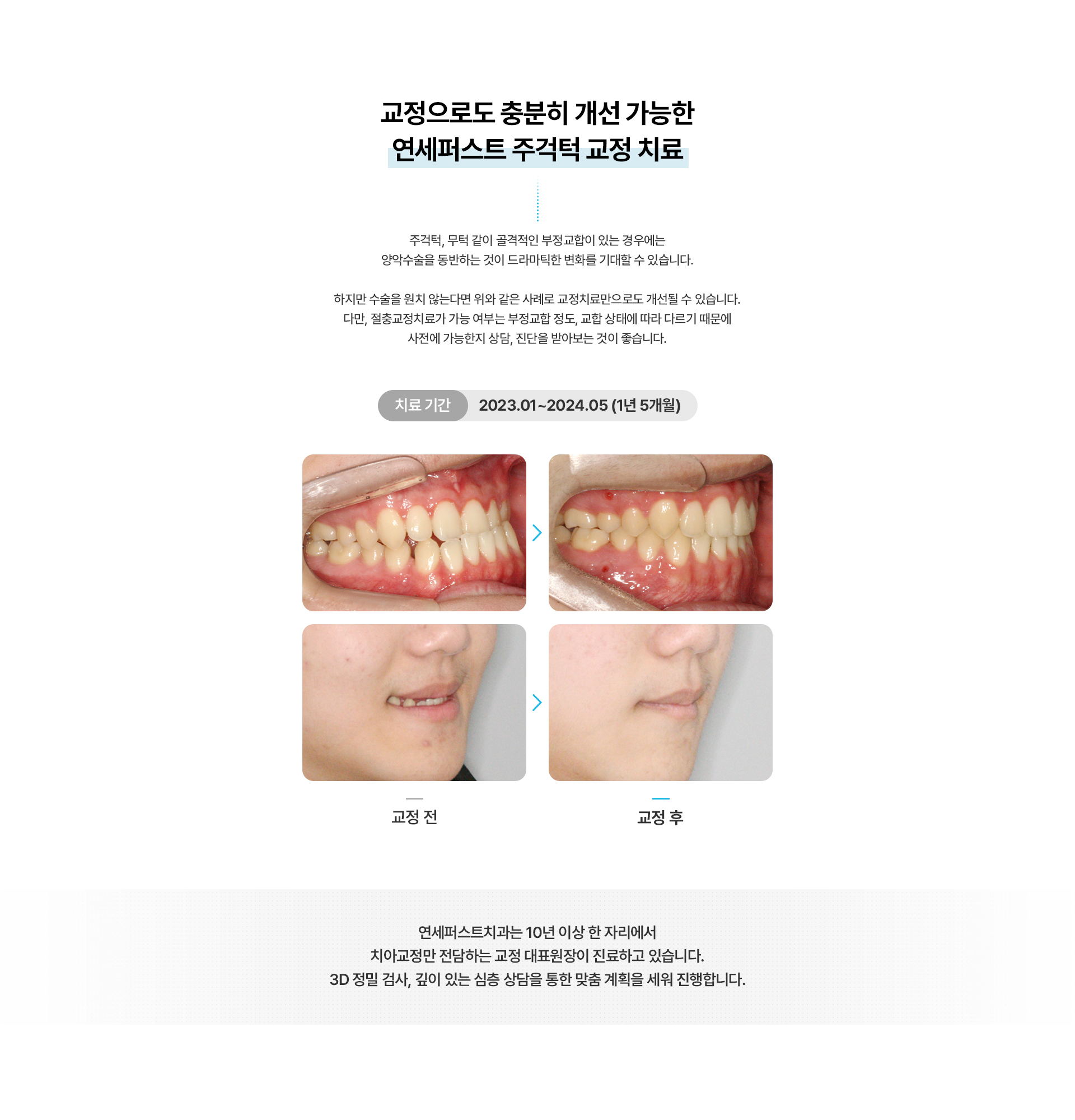 주걱턱교정