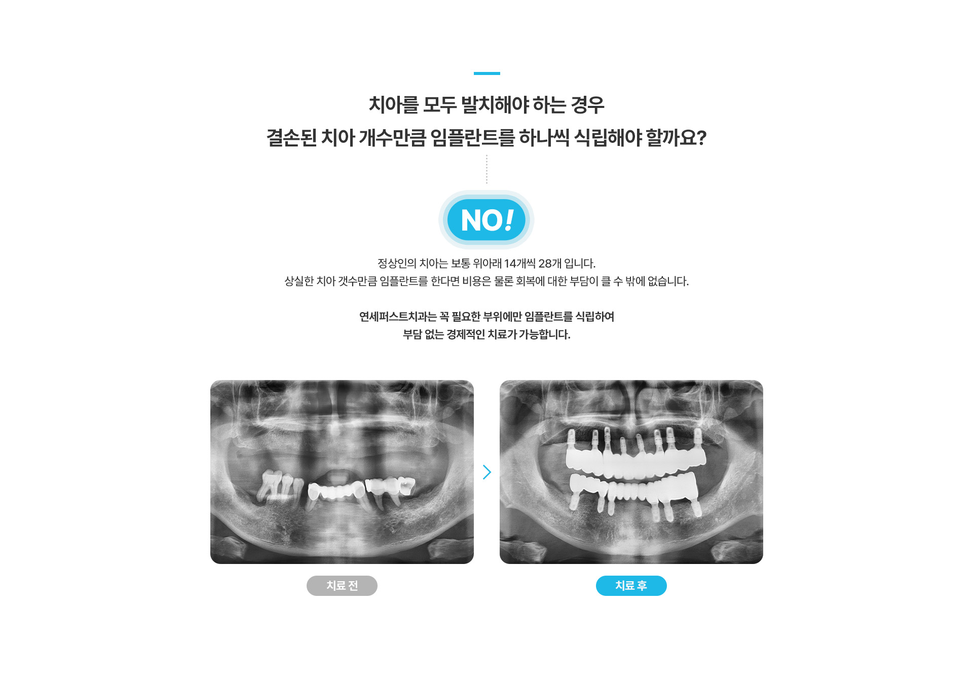 전체임플란트