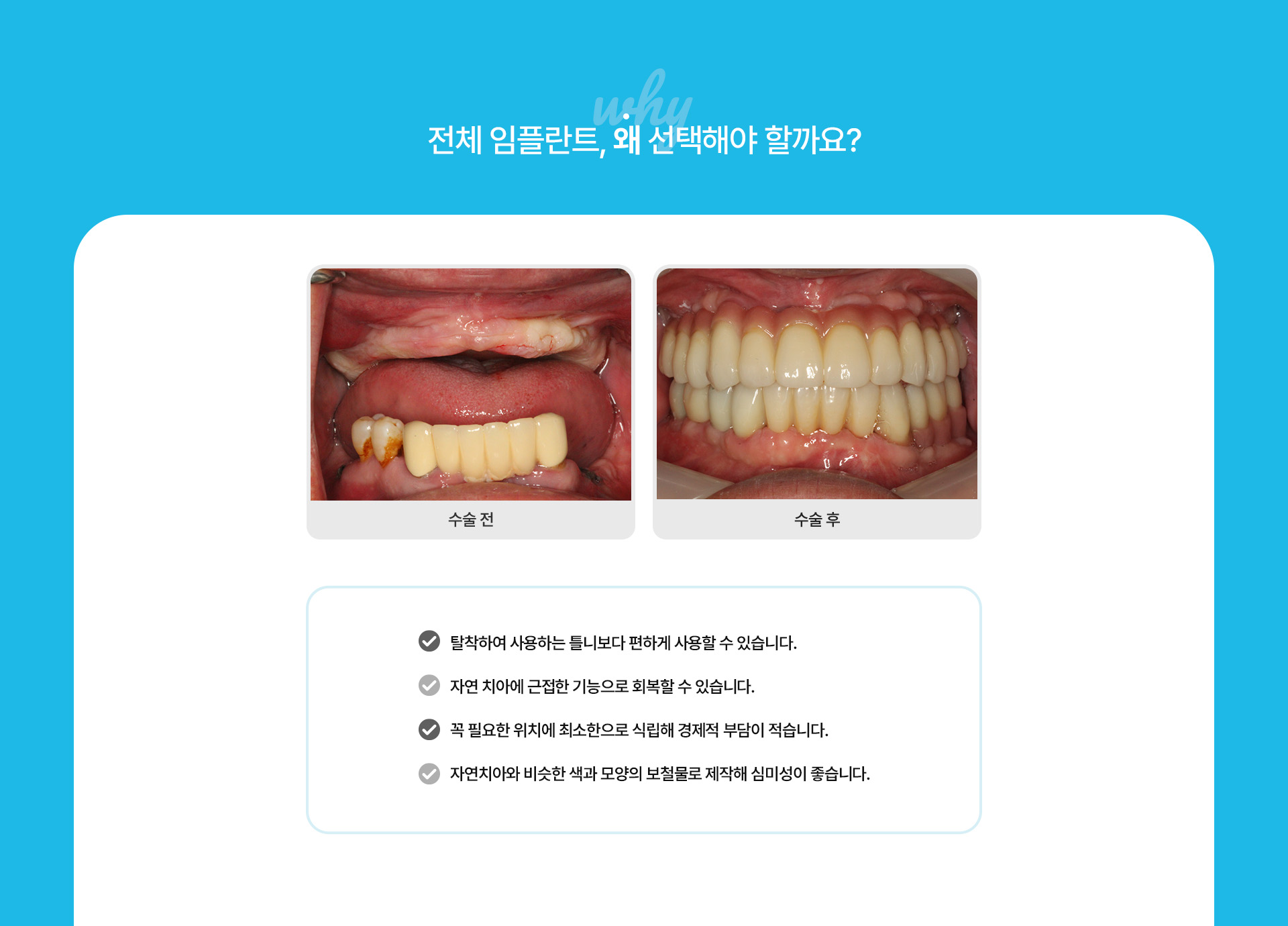 전체임플란트