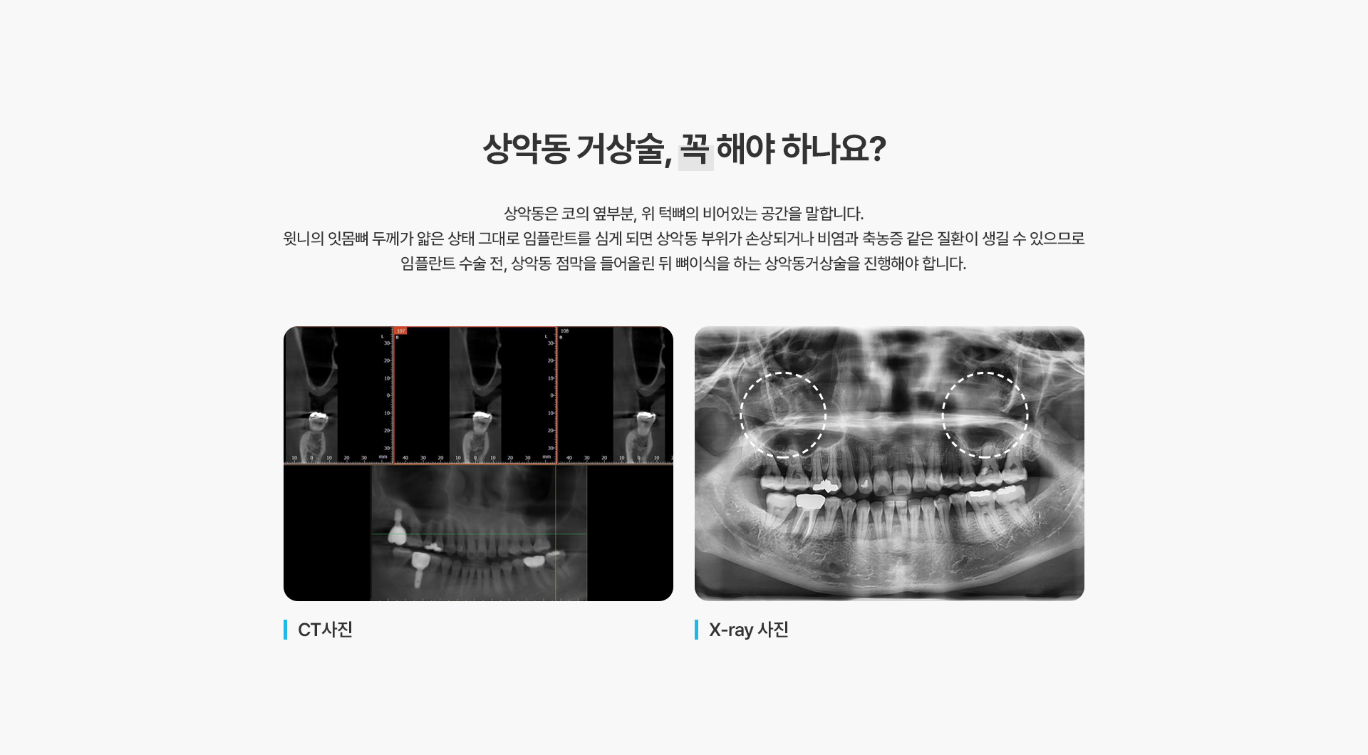 상악동거상술(CAS, LAS)