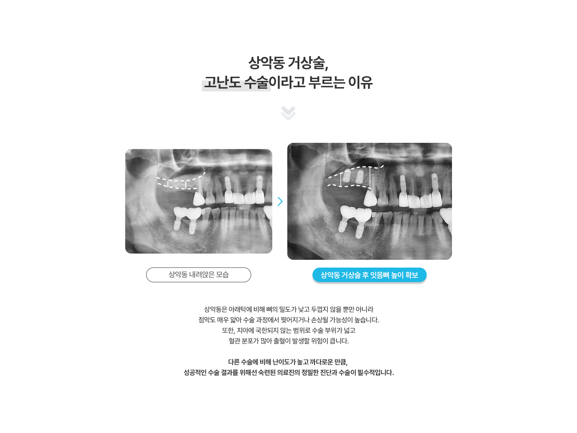 상악동거상술(CAS, LAS)