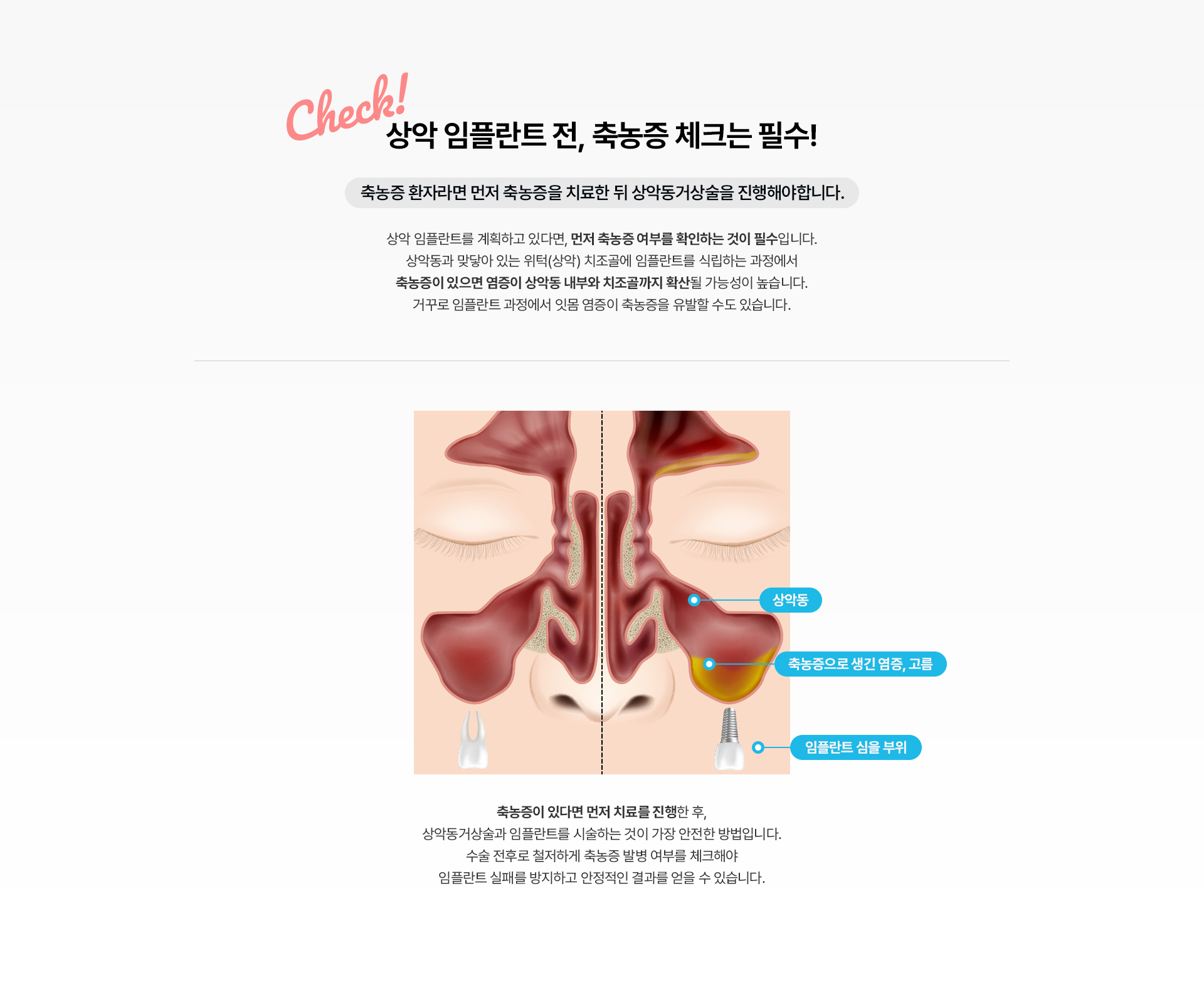 상악동거상술(CAS, LAS)
