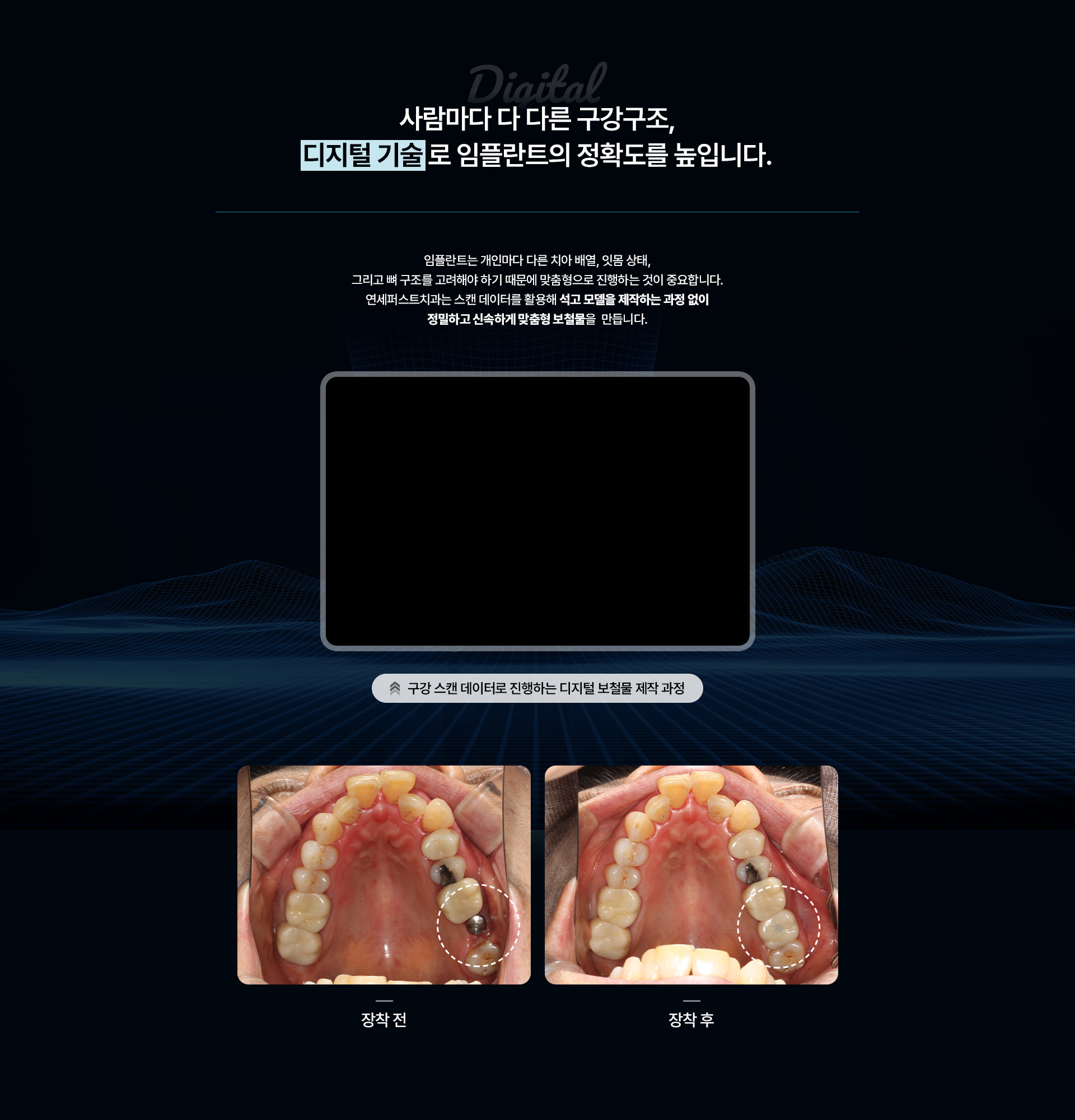 디지털 임플란트 보철