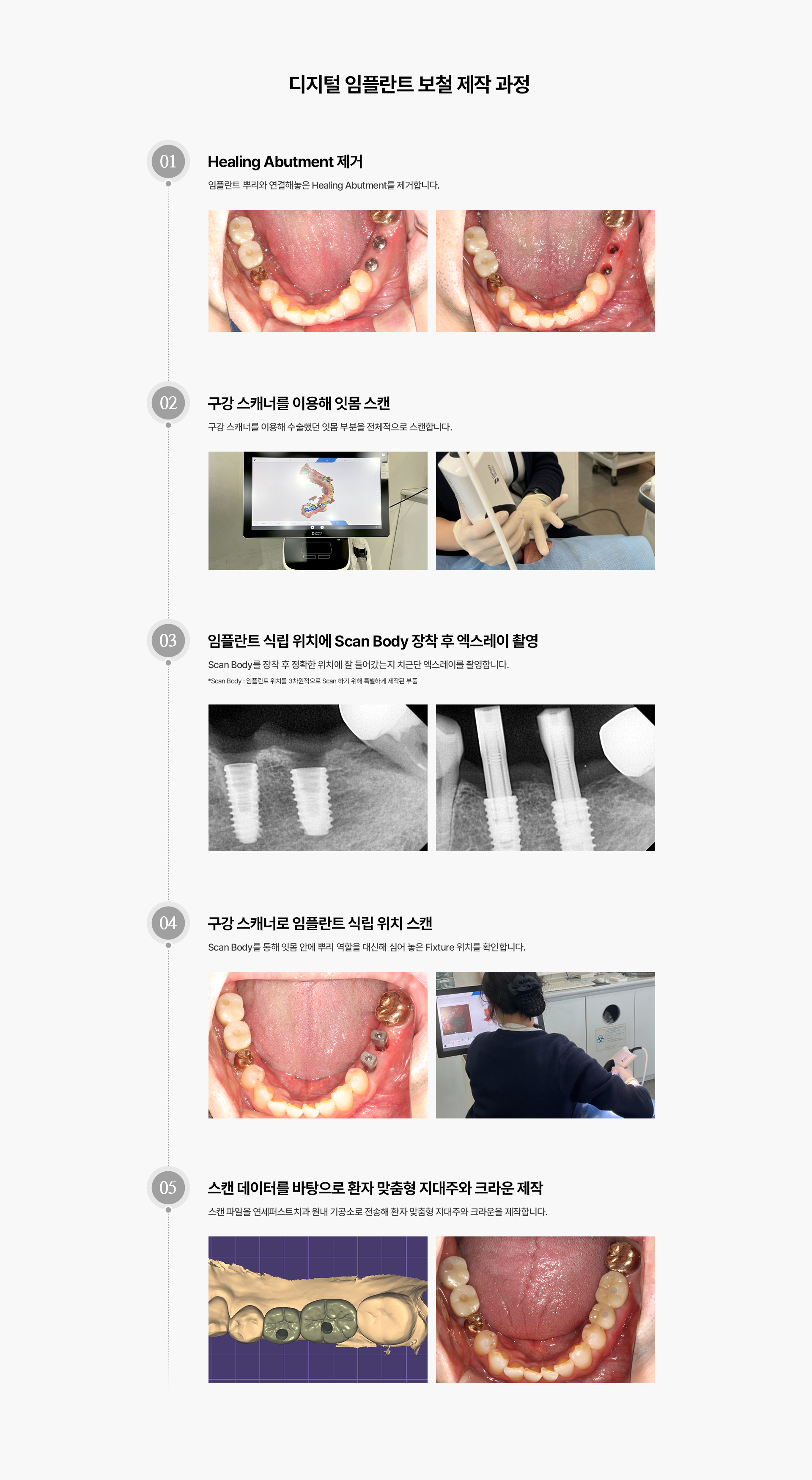 디지털 임플란트 보철