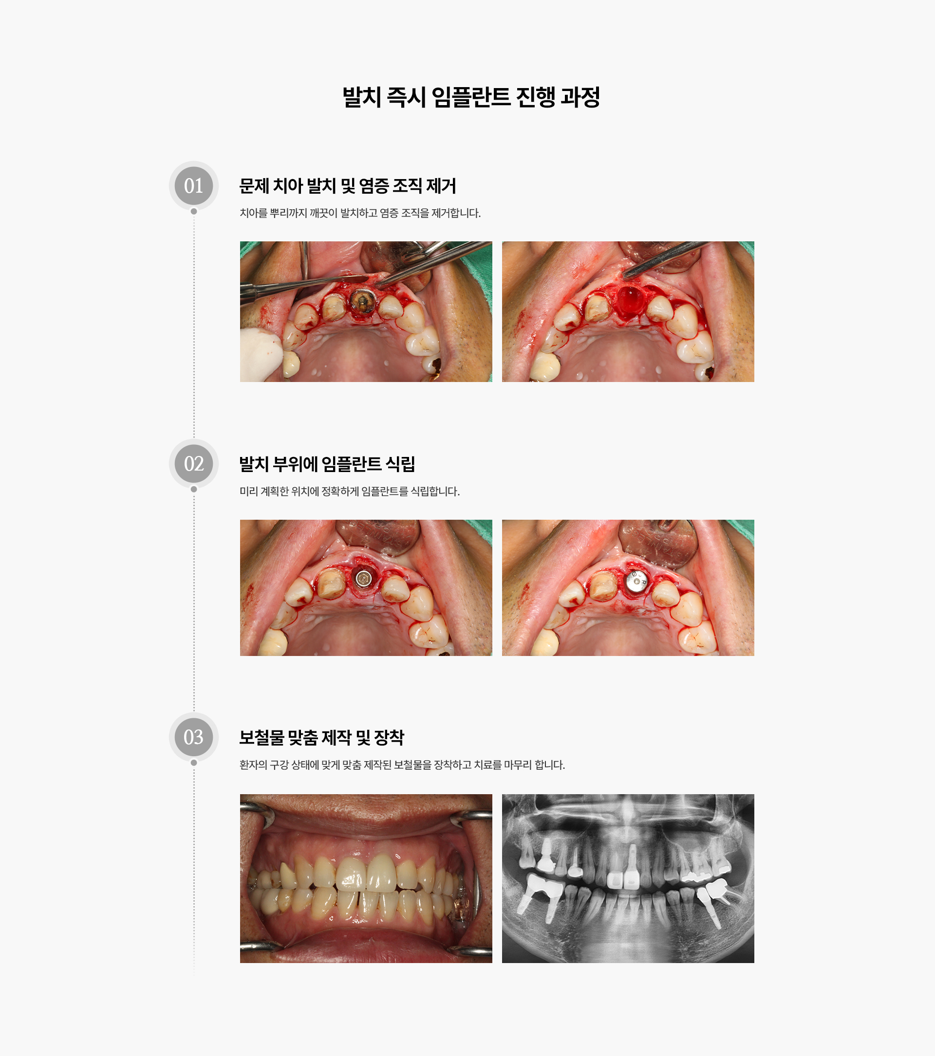 발치즉시임플란트