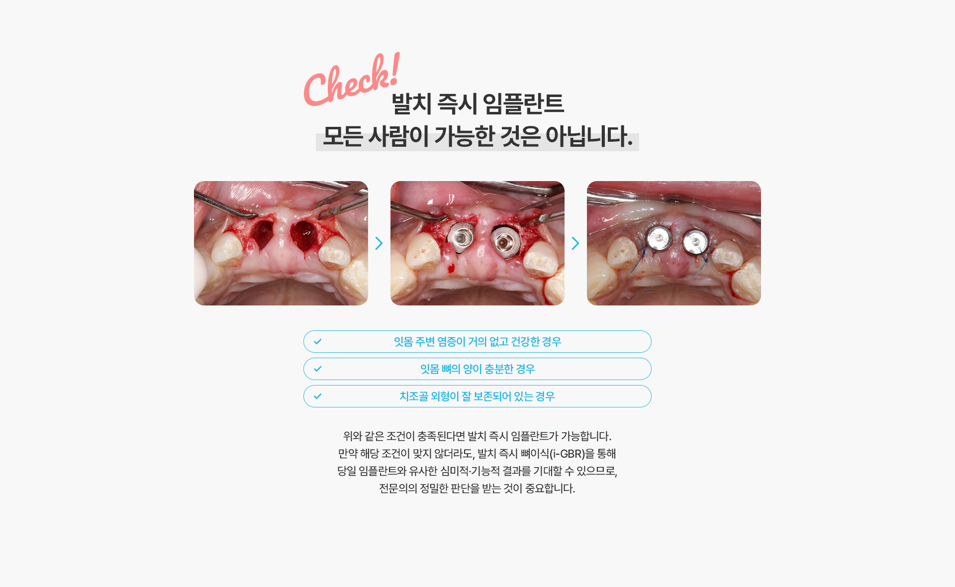 발치즉시임플란트