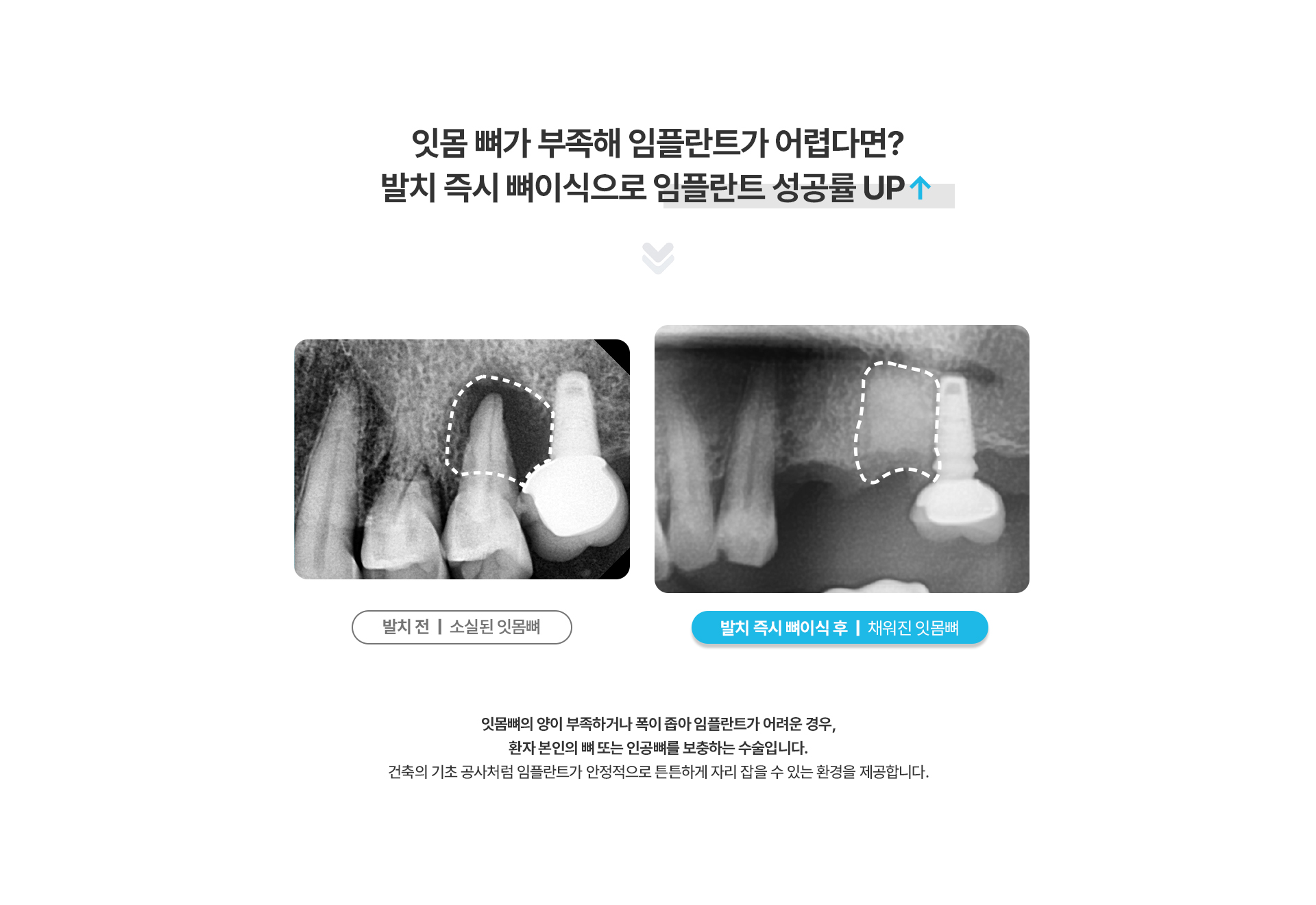 i-GBR 발치 즉시 뼈이식