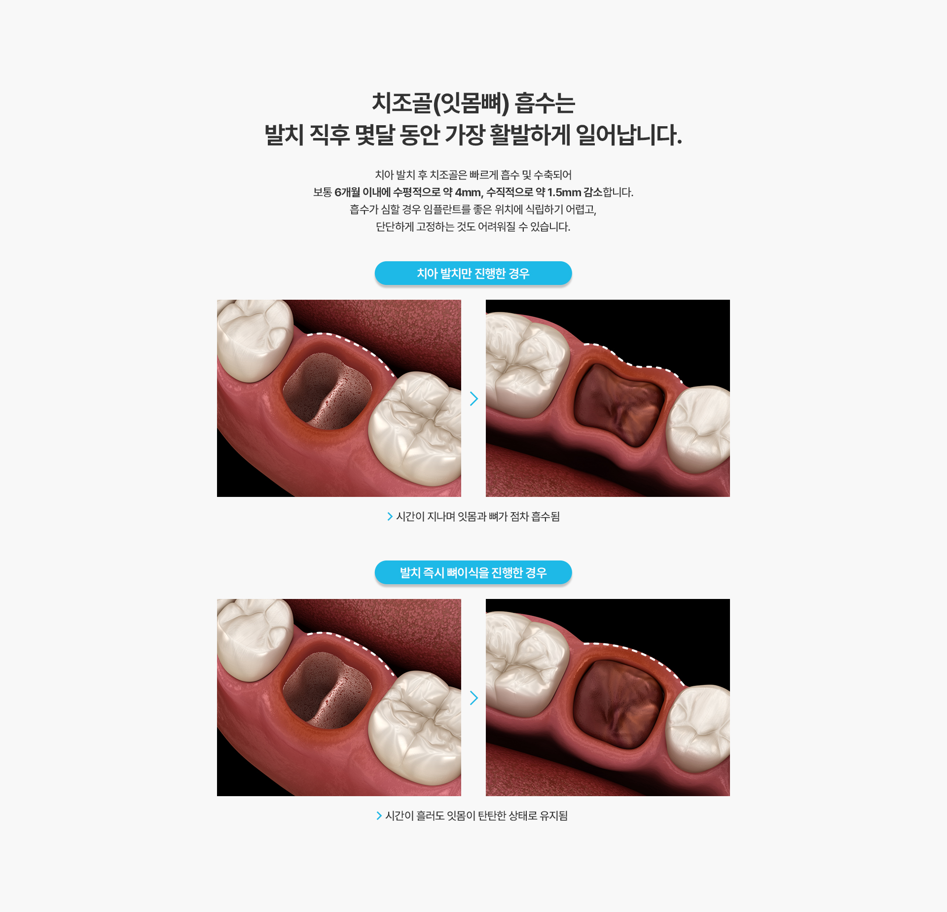 i-GBR 발치 즉시 뼈이식