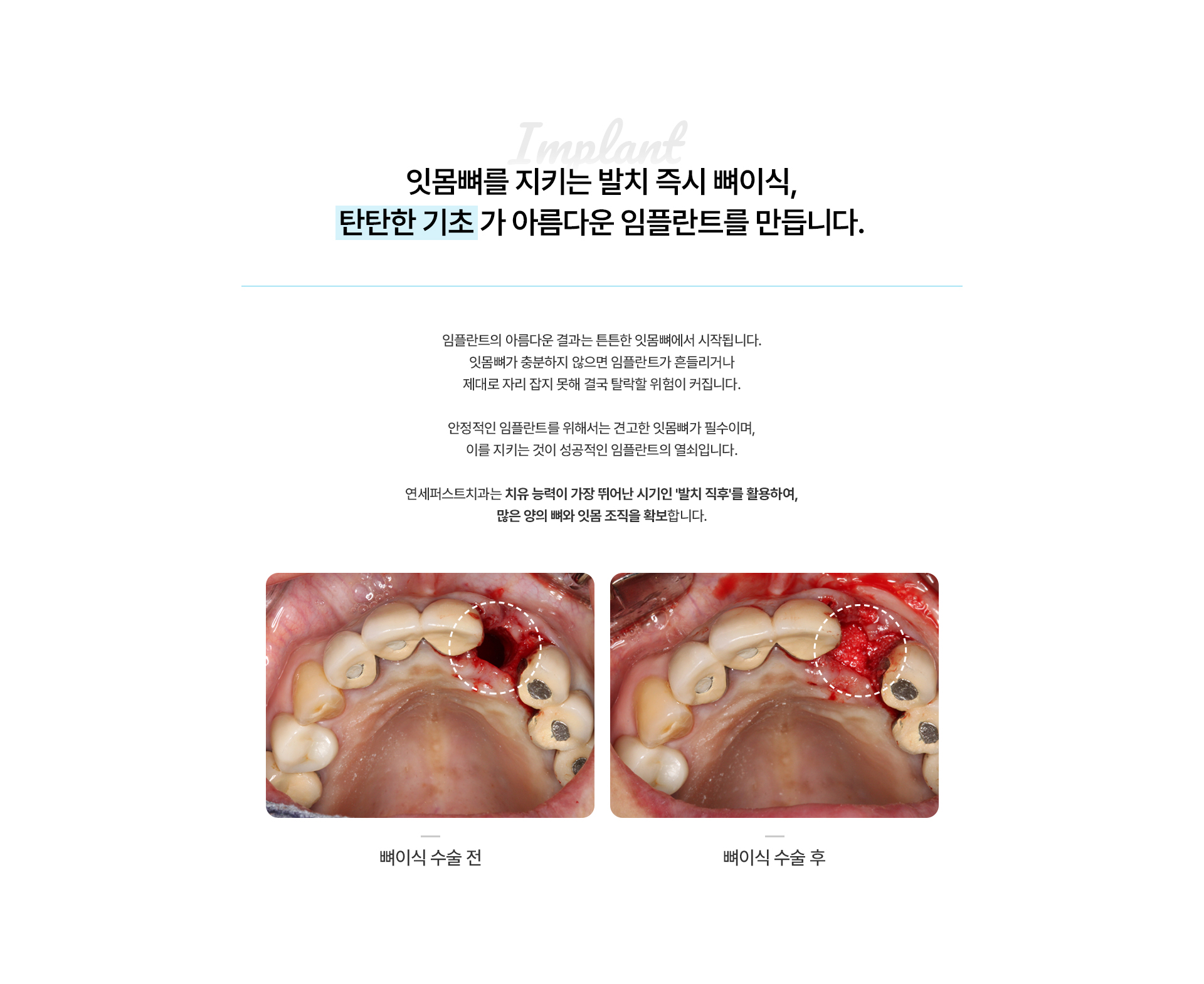 i-GBR 발치 즉시 뼈이식