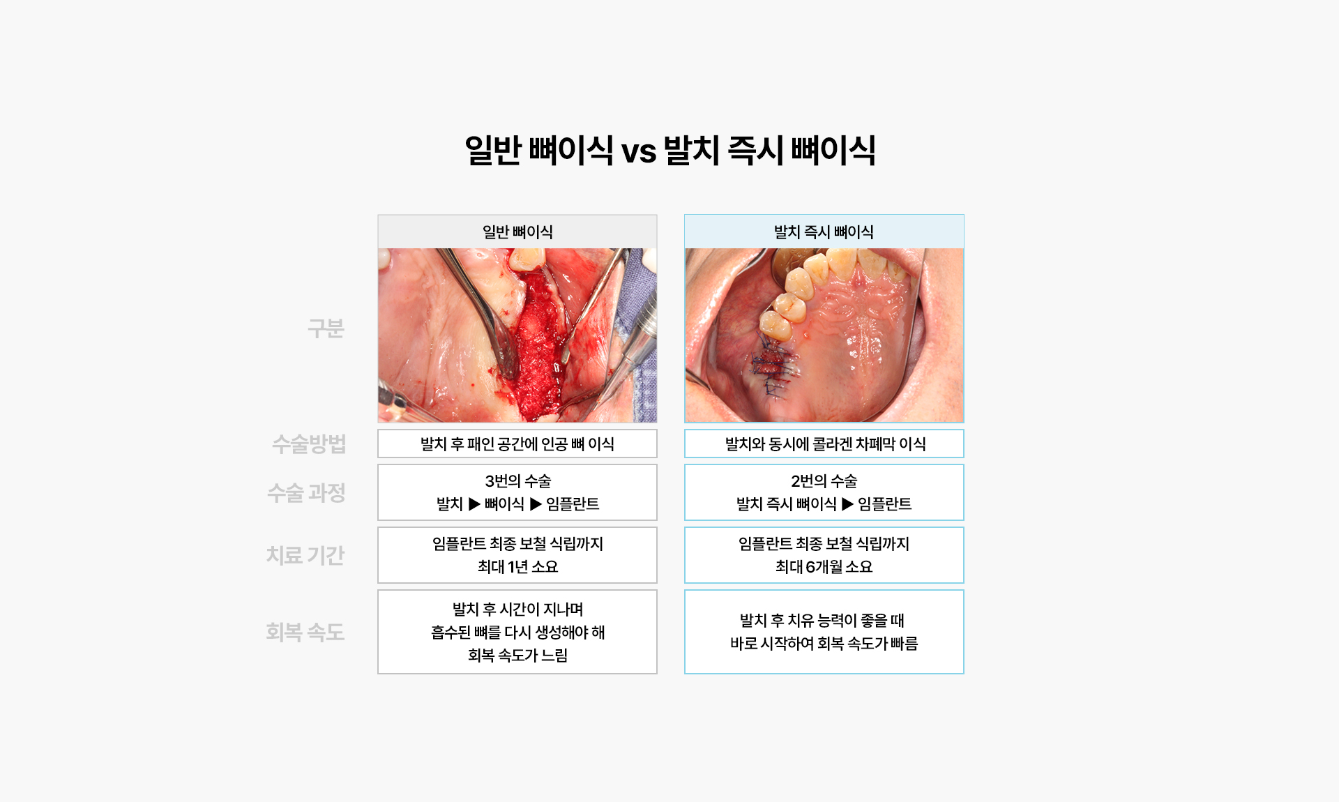 i-GBR 발치 즉시 뼈이식