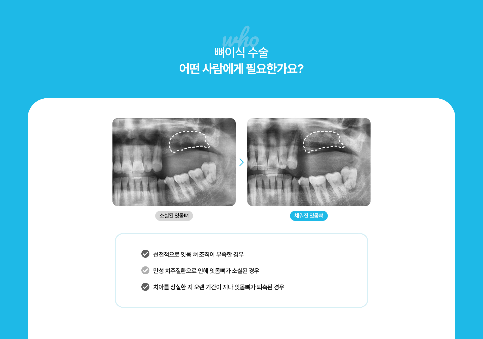 i-GBR 발치 즉시 뼈이식