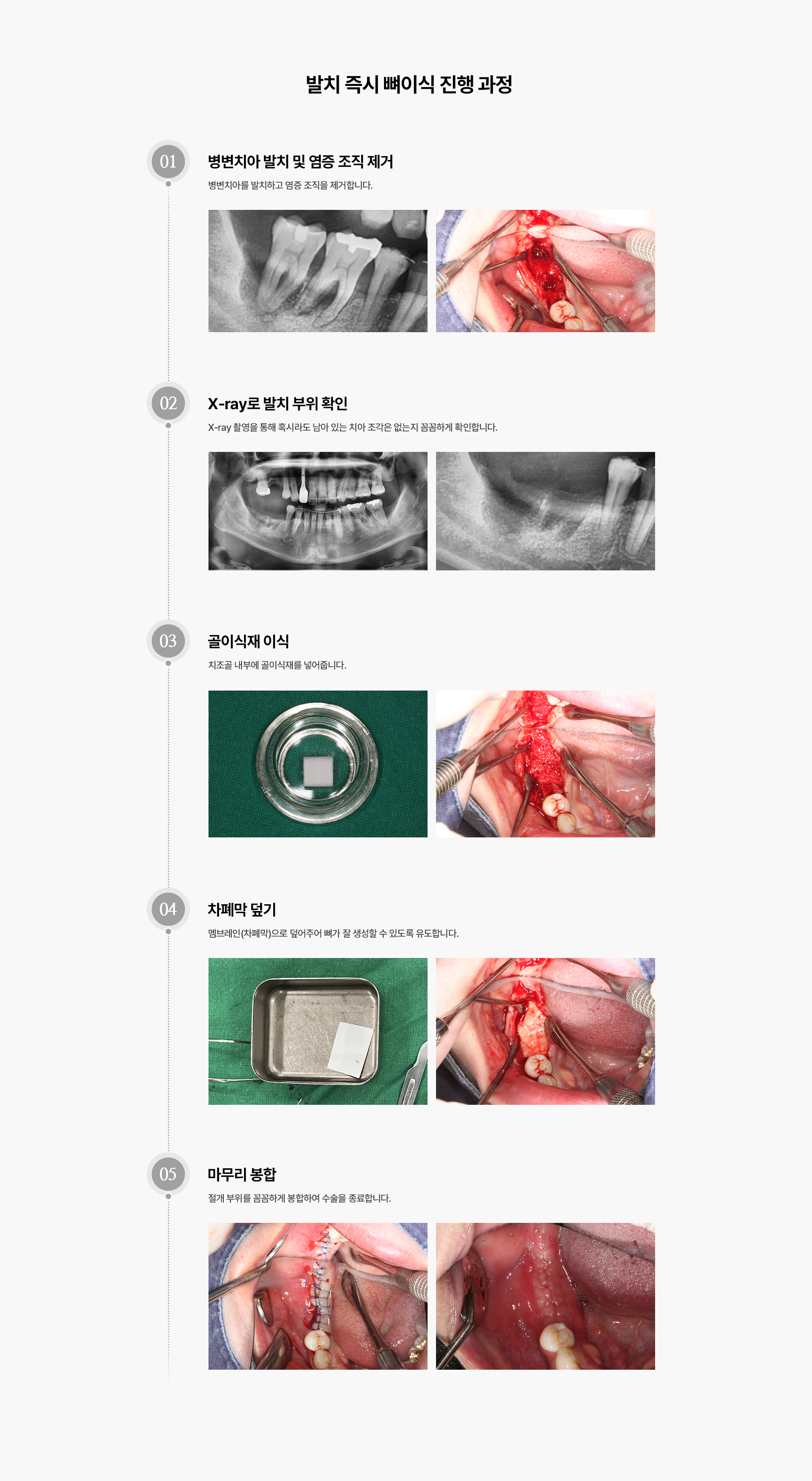 i-GBR 발치 즉시 뼈이식