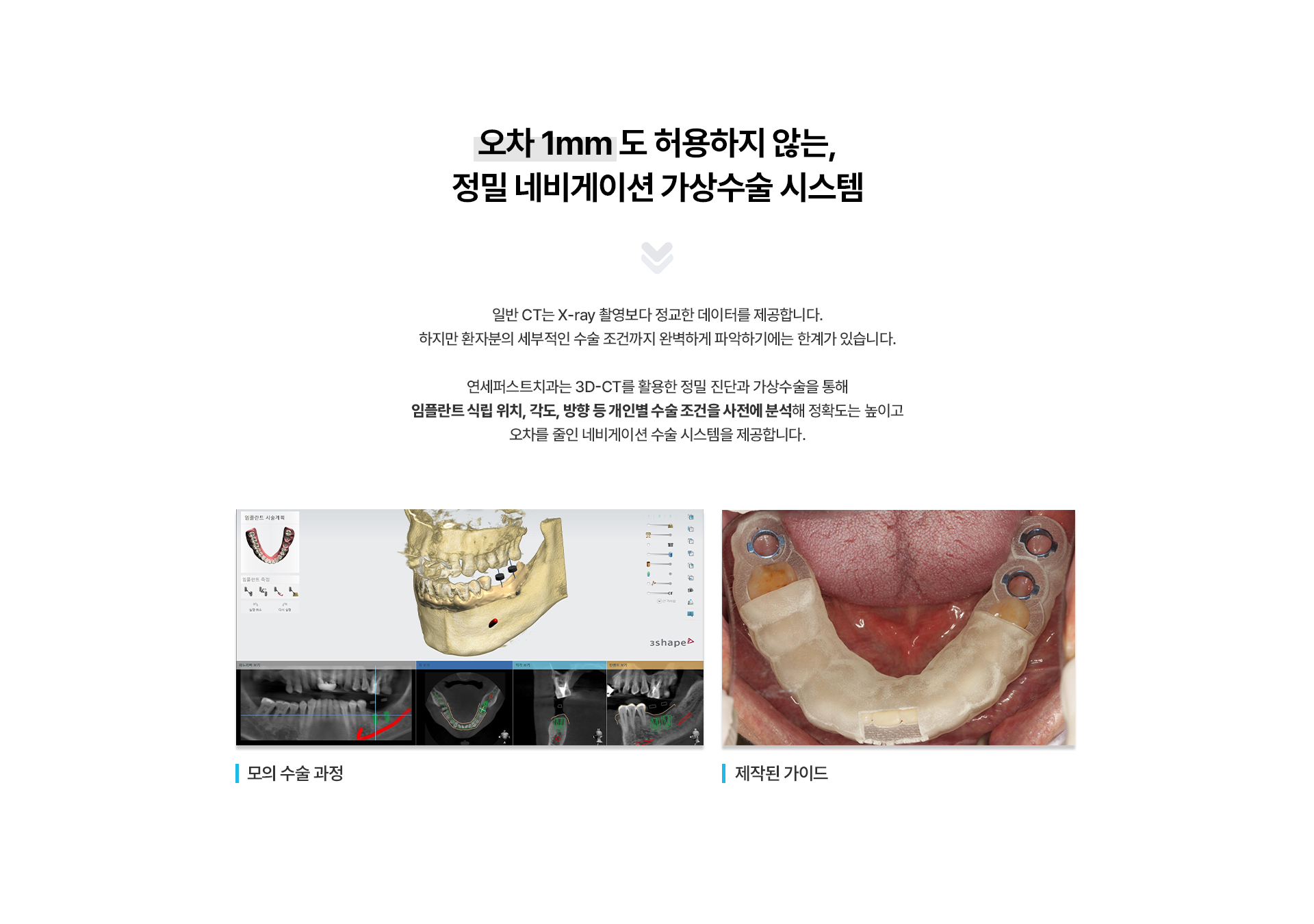 네비게이션최소절개임플란트