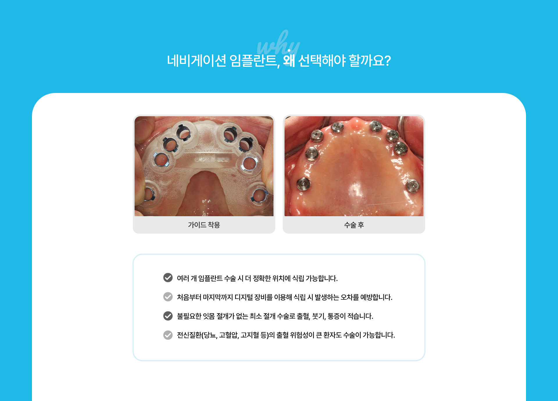 네비게이션최소절개임플란트